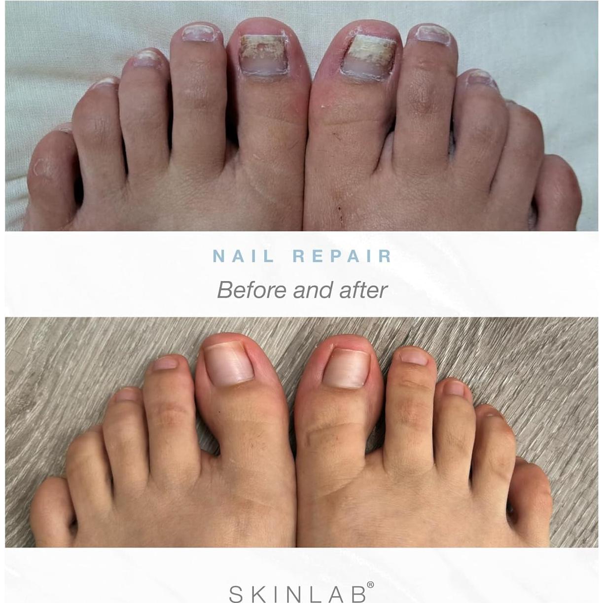 Suero Reparador de Uñas Skinlab - Fortalecedor Hipoalergénico