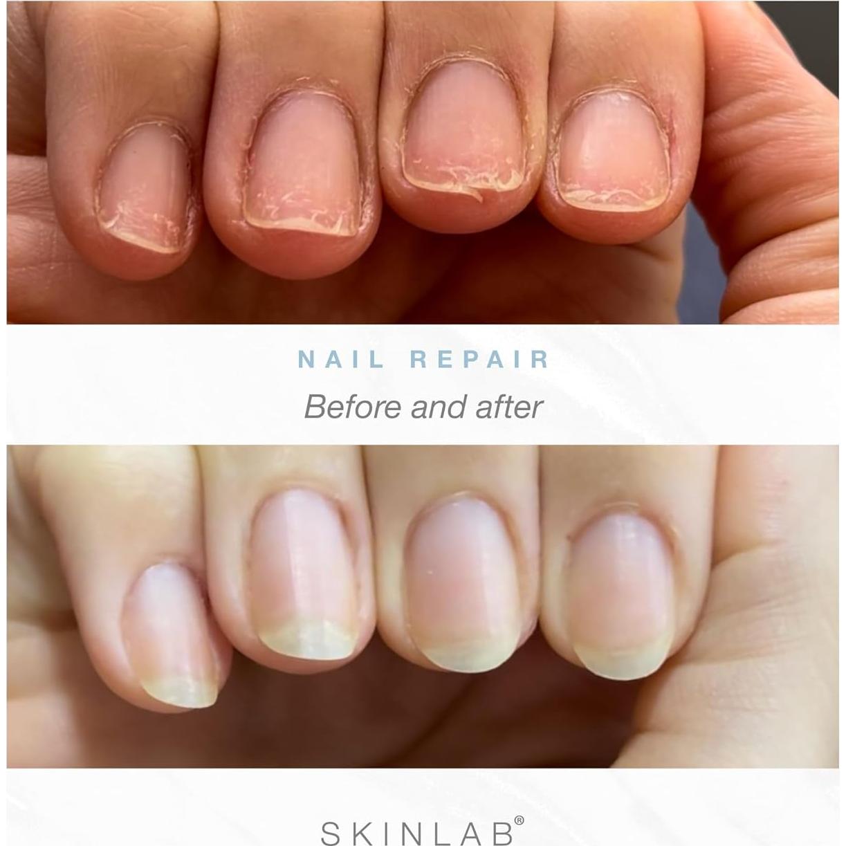 Suero Reparador de Uñas Skinlab - Fortalecedor Hipoalergénico