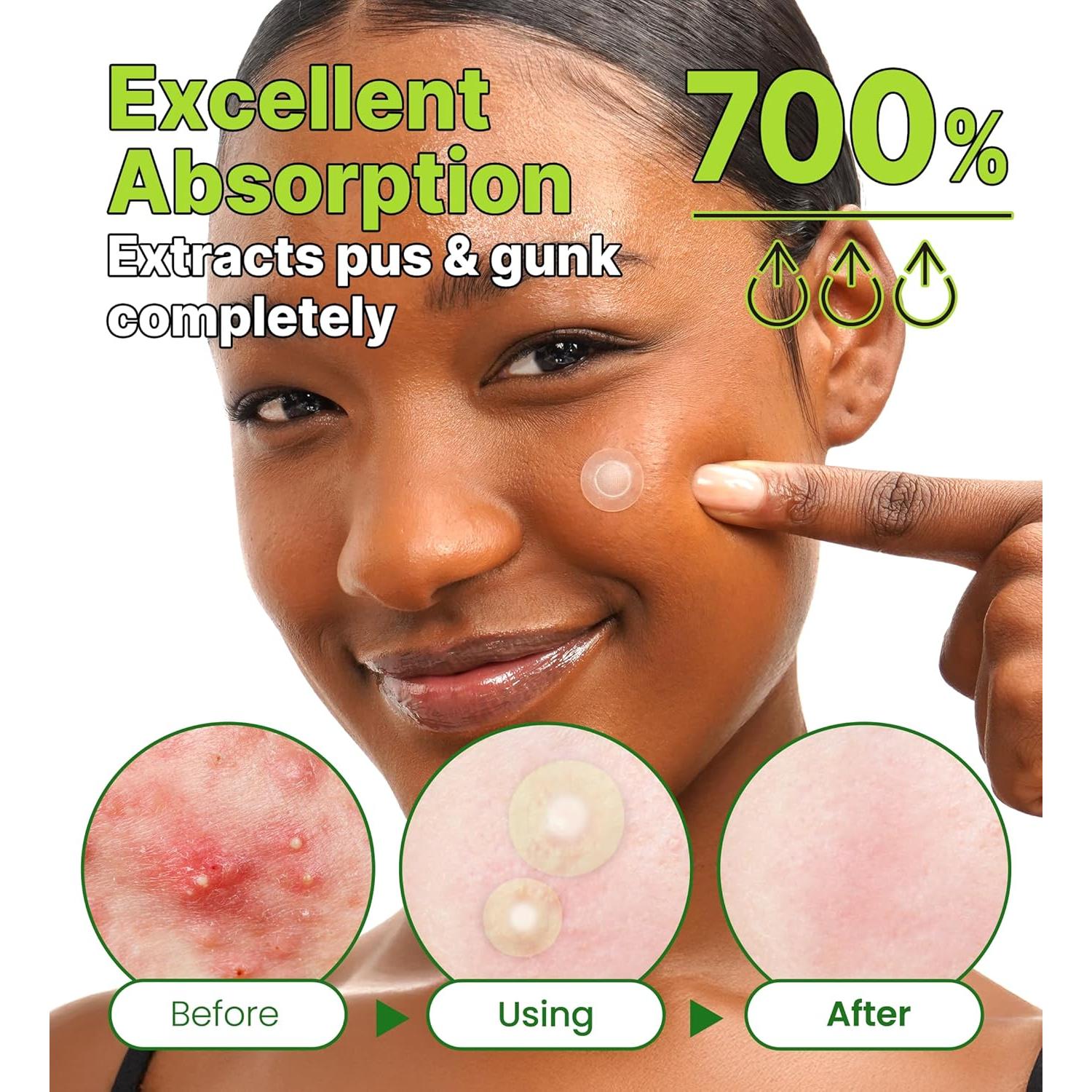 Parche Hidrocoloide Troubless para Granitos - 96 Unidades