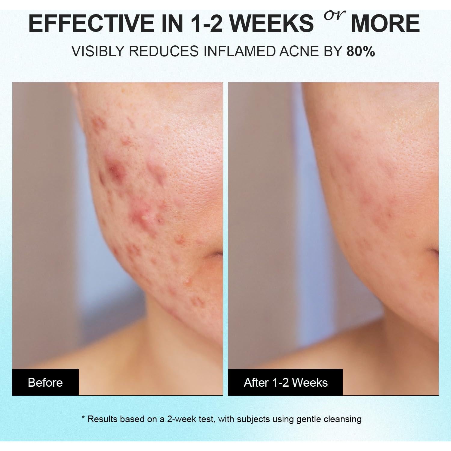 Crema Anti-Acné Enaskin Naturals 51 g - 10% Ácido Azelaico