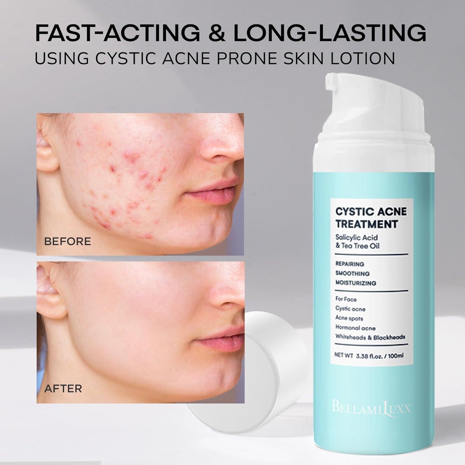 Crema Tratamiento Acné Quístico BellamiLuxx 149g - Hidratante Anti-Acné