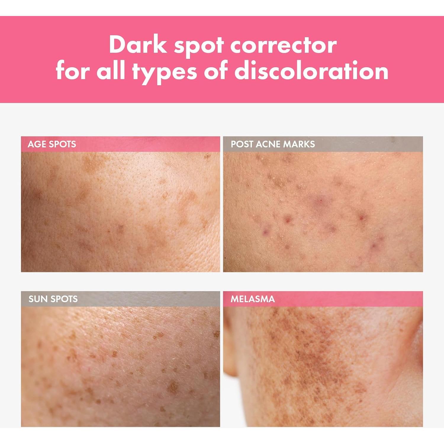 Crema Intensiva para Manchas Tosowoong 20ml - 7% Arbutina