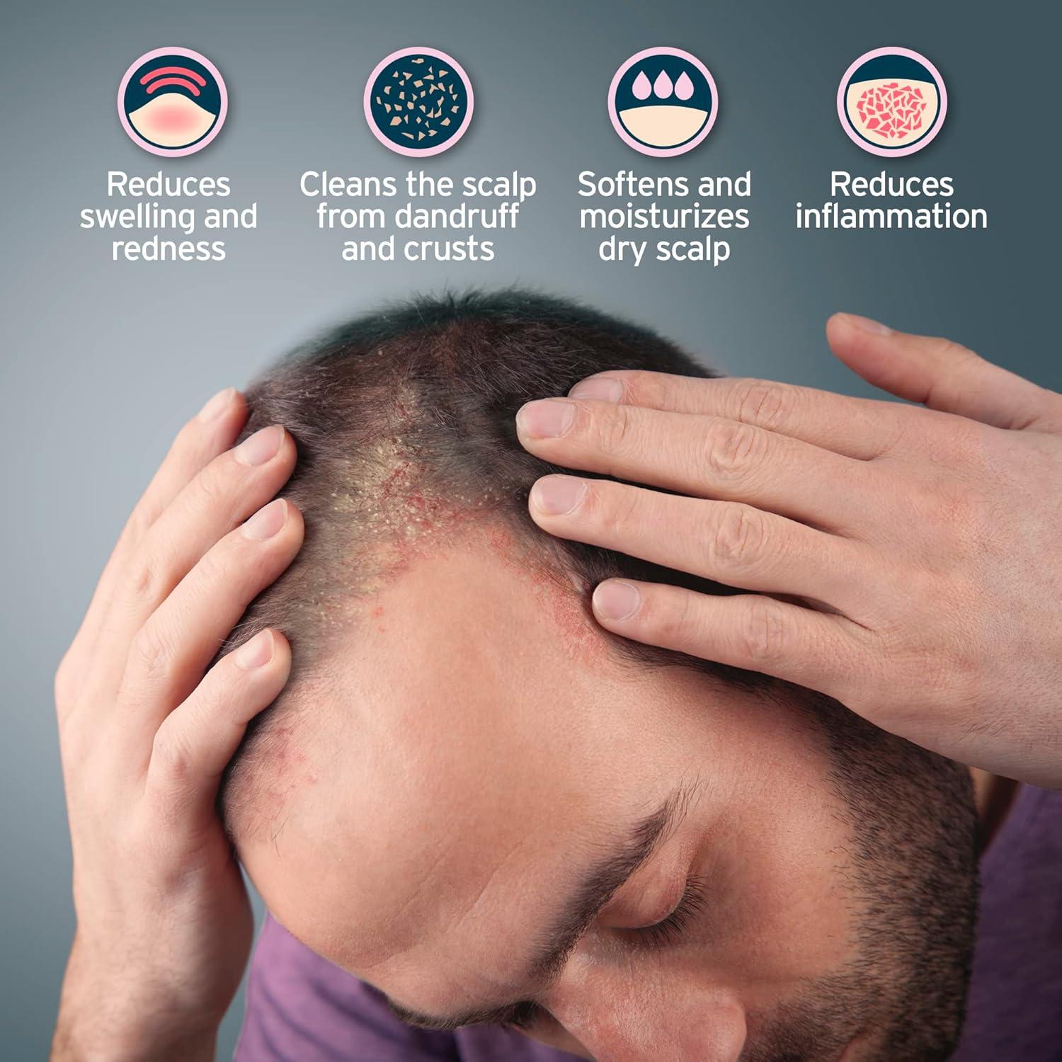 Champú Terapéutico Sphagnum Botanicals 239g - Ácido Salicílico y Barro de Turba para Dermatitis Seborreica