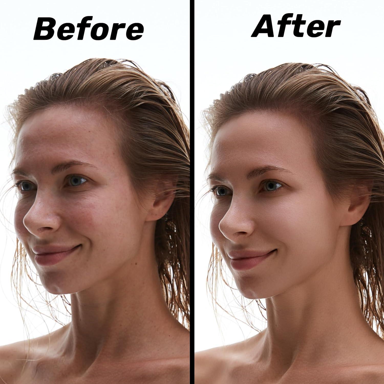 Jabón Natural para Acné Fitkara 141g - Piel Sensible