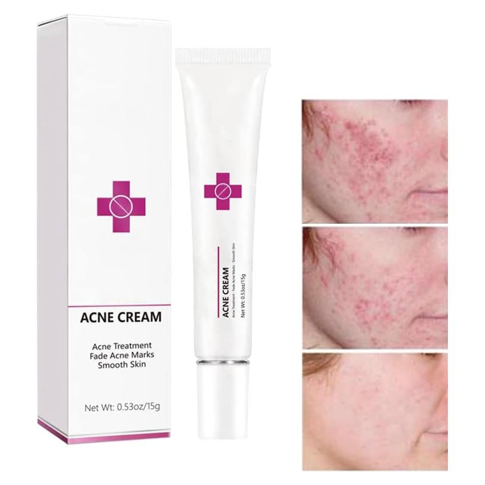 Crema para el Acné Onkessy 15 ml - Control de Aceite y Espinillas