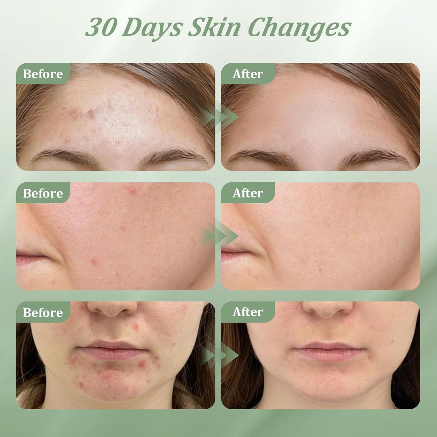 Crema Tratamiento Acné Bablabear 30g 2% Ácido Salicílico