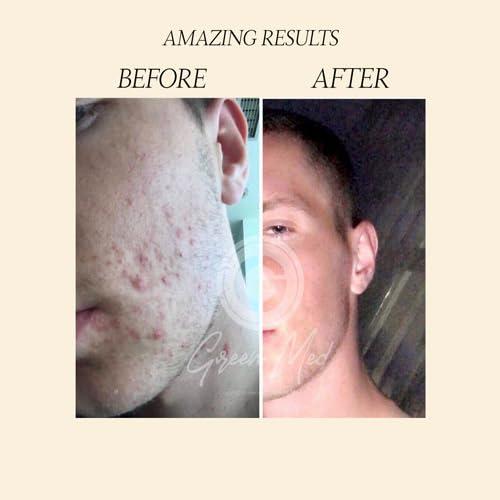 Jabón Negro Africano Green Med 79.9g - Limpieza Profunda y Regeneración