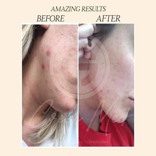 Jabón Negro Africano Green Med 79.9g - Limpieza Profunda y Regeneración