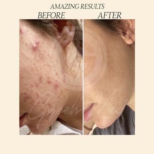 Jabón Negro Africano Green Med 79.9g - Limpieza Profunda y Regeneración