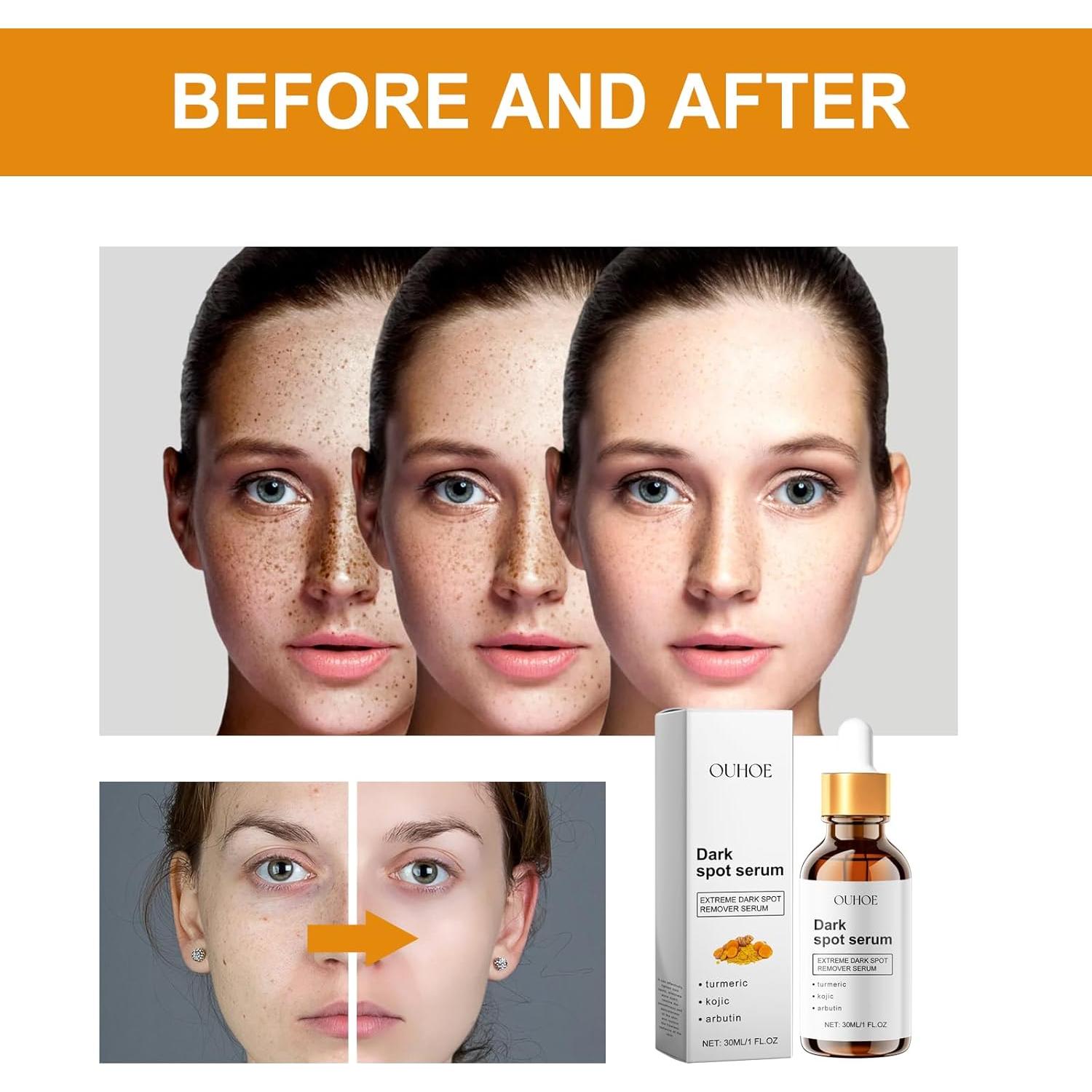 Suero Iluminador de Ácido Kójico y Cúrcuma 29.57 ml