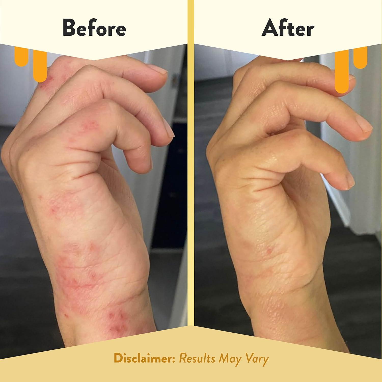 Jabón Corporal Eczema Honey 500ml + Aceite Hidratante 250ml