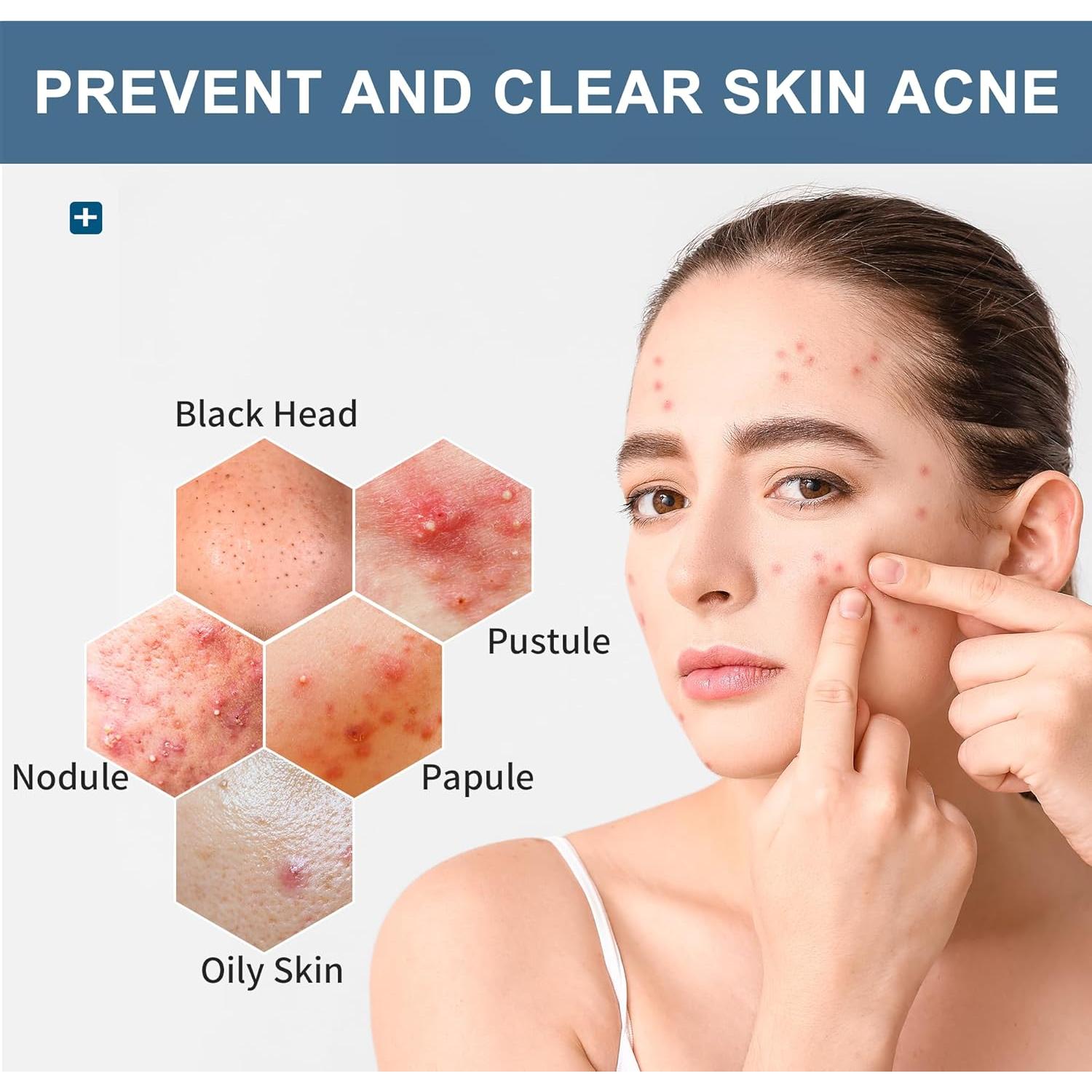 Toallitas Tratamiento Acné Natouch 321g con Ácido Salicílico