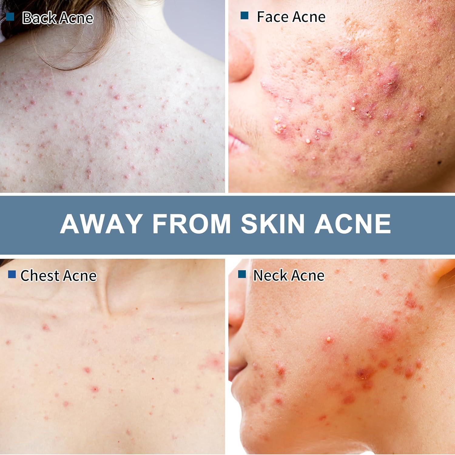 Toallitas Tratamiento Acné Natouch 321g con Ácido Salicílico