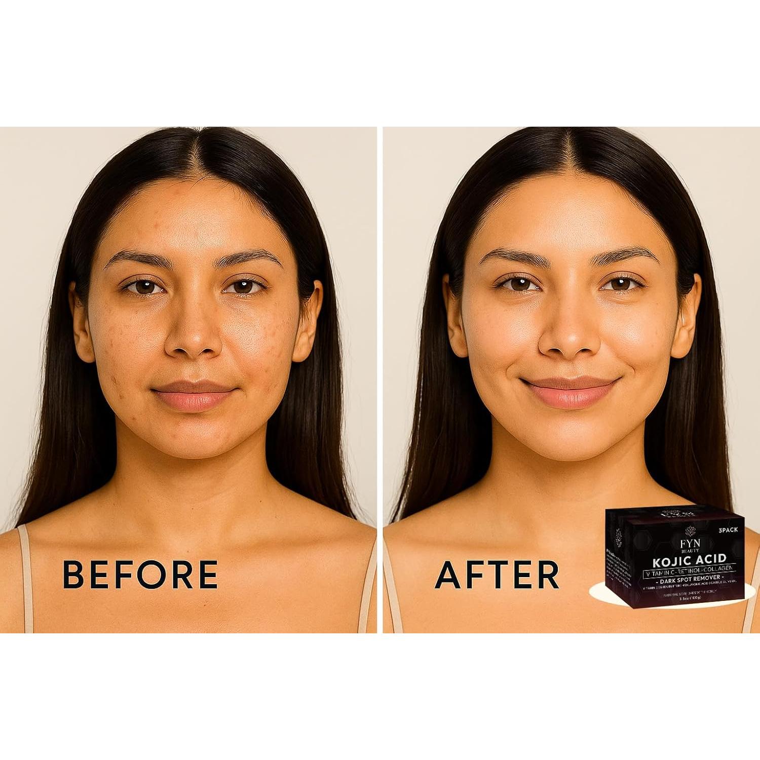 Jabón de Ácido Kójico FYN Beauty - 3 Piezas para Manchas y Rejuvenecimiento