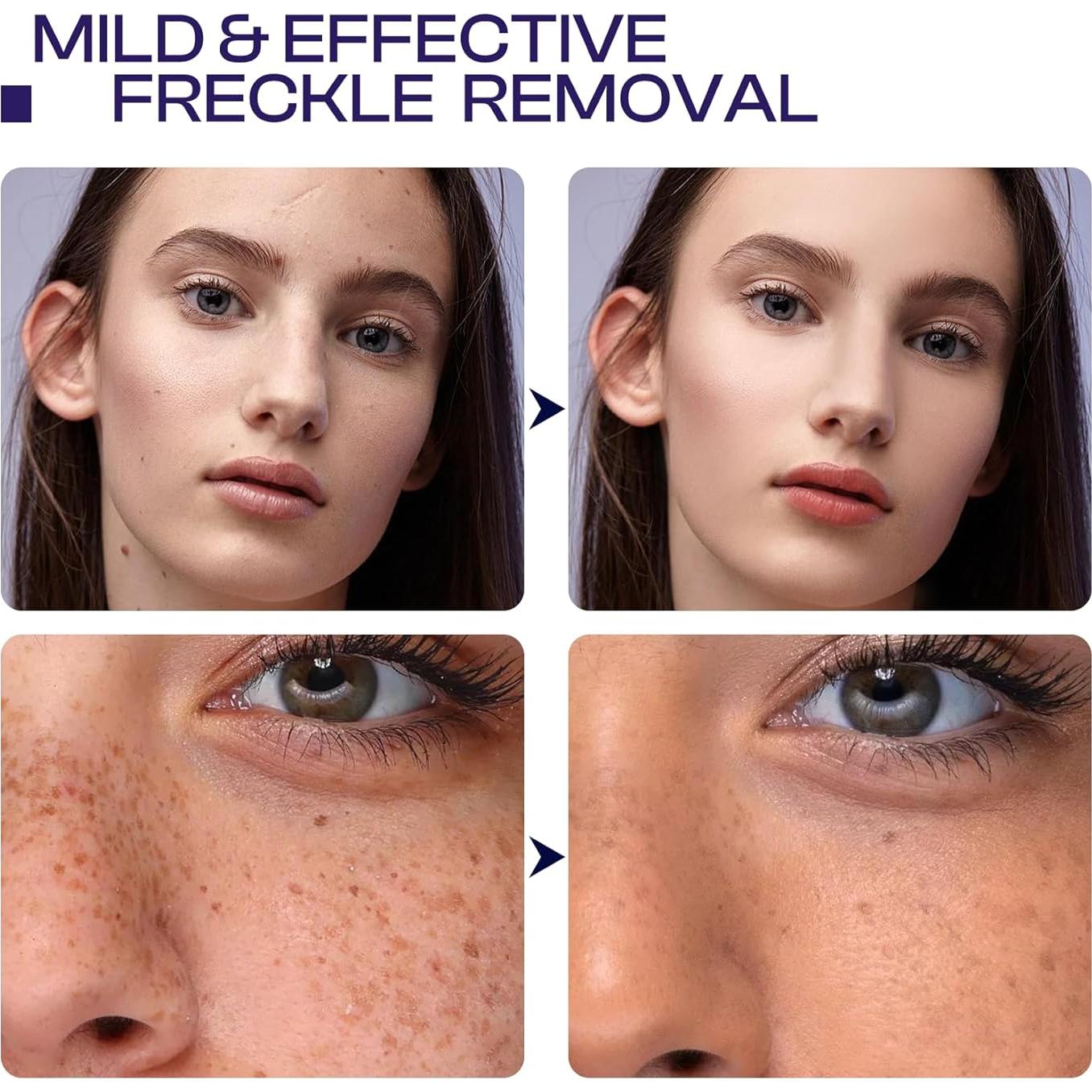 Removedor de Manchas Oscuras LHOPEBK 50ml con Niacinamida y Vitamina C