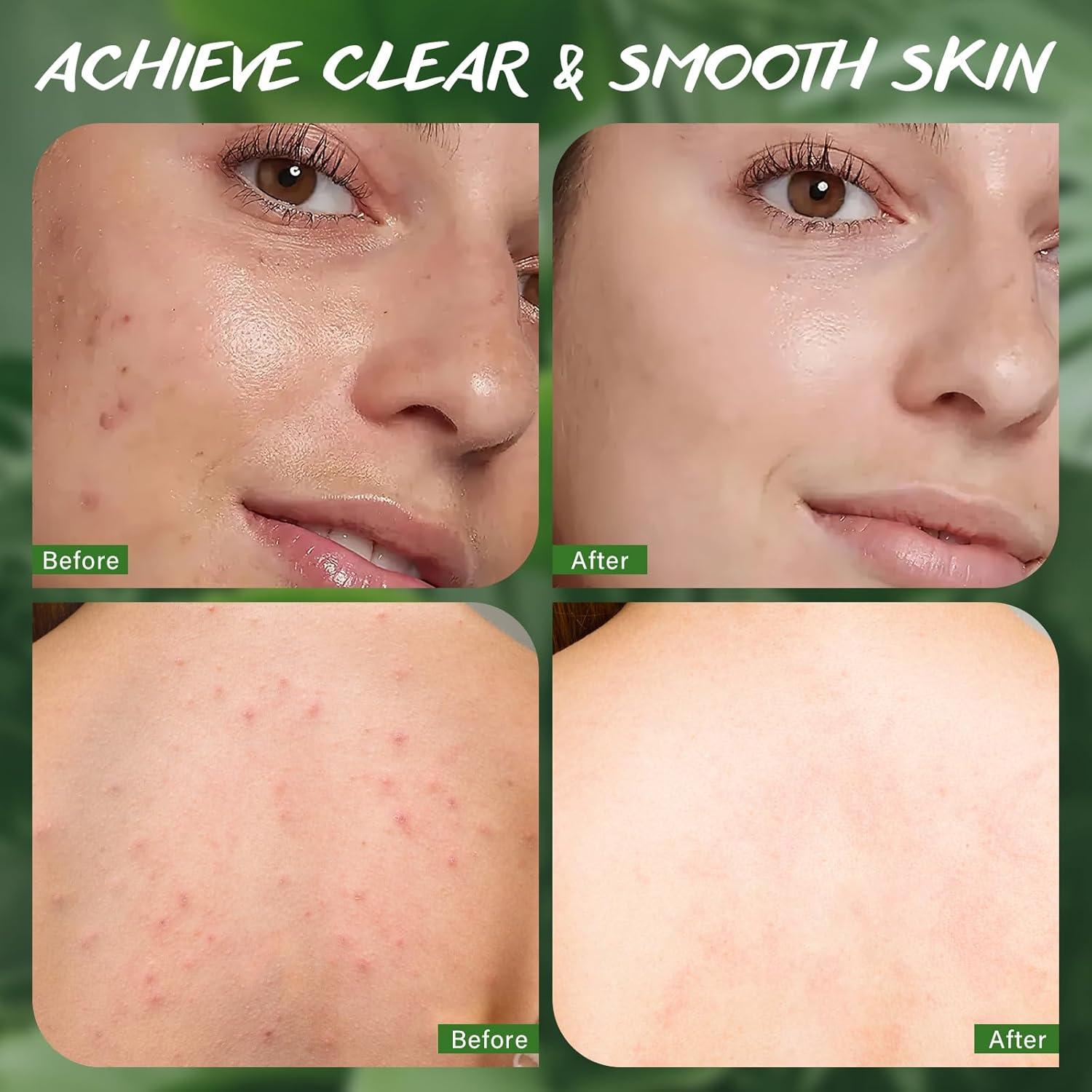 Jabón de Árbol de Té 3x100g - Limpieza Facial y Corporal