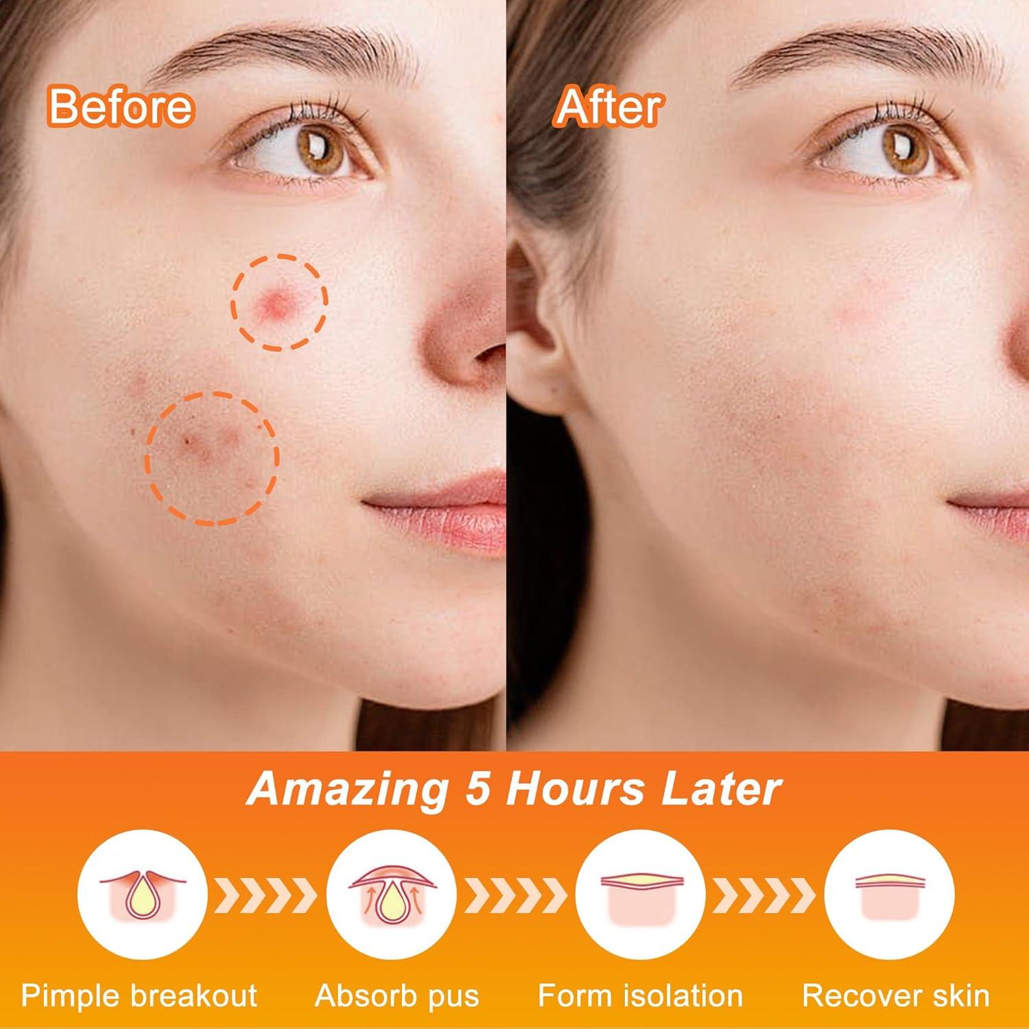 Parche para Granos CELECARE Halloween 100PCS Hidrocoloides