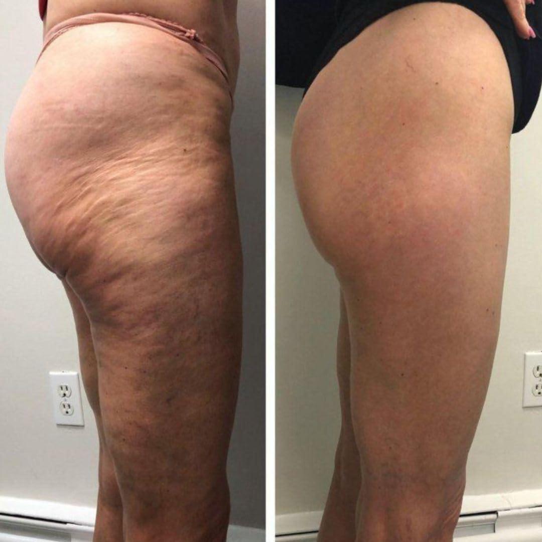 Crema Bum Bum IT 226.8g - Reafirmante y Elevadora para Celulitis