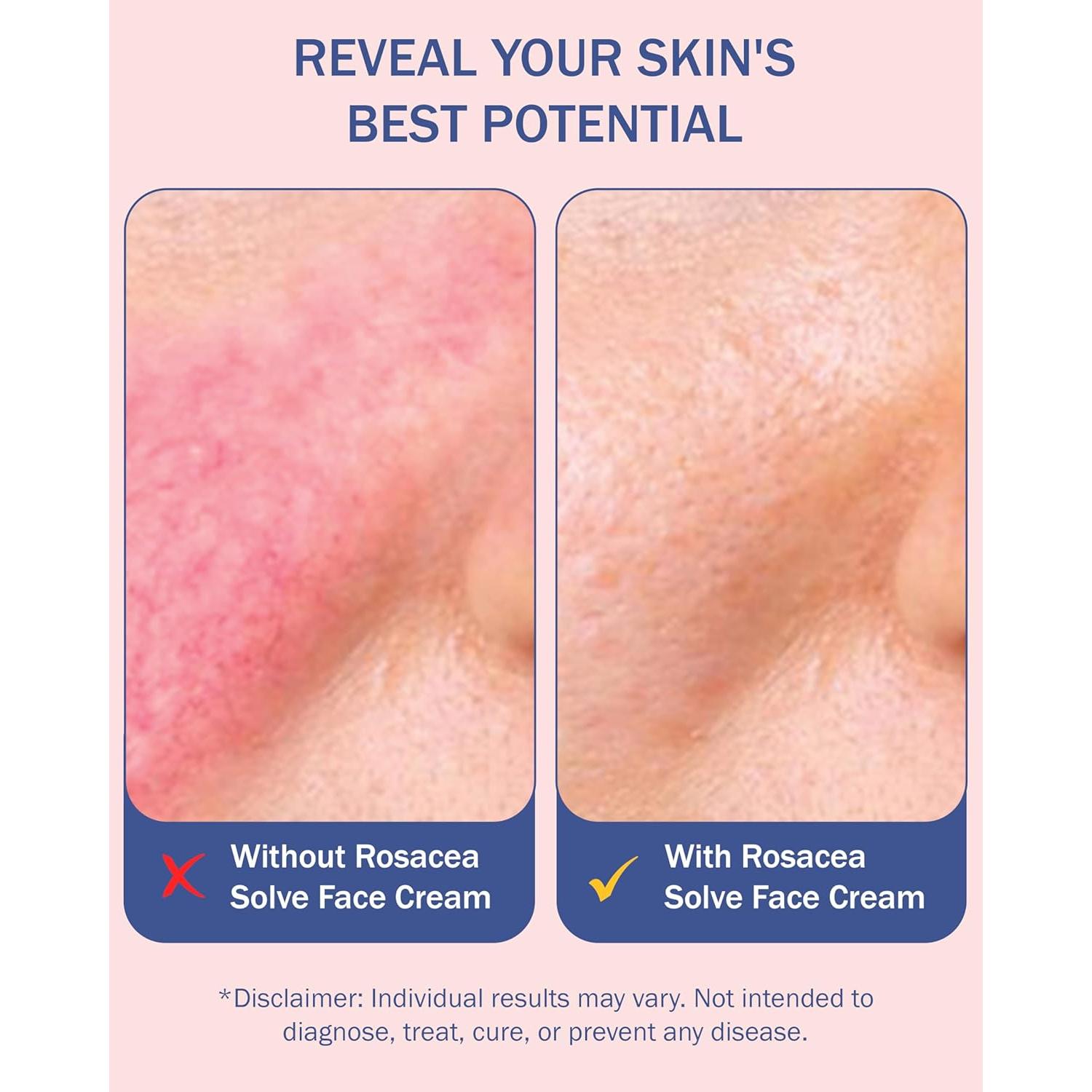 Crema Hidratante Facial e70 para Rosácea - Paquete de 2