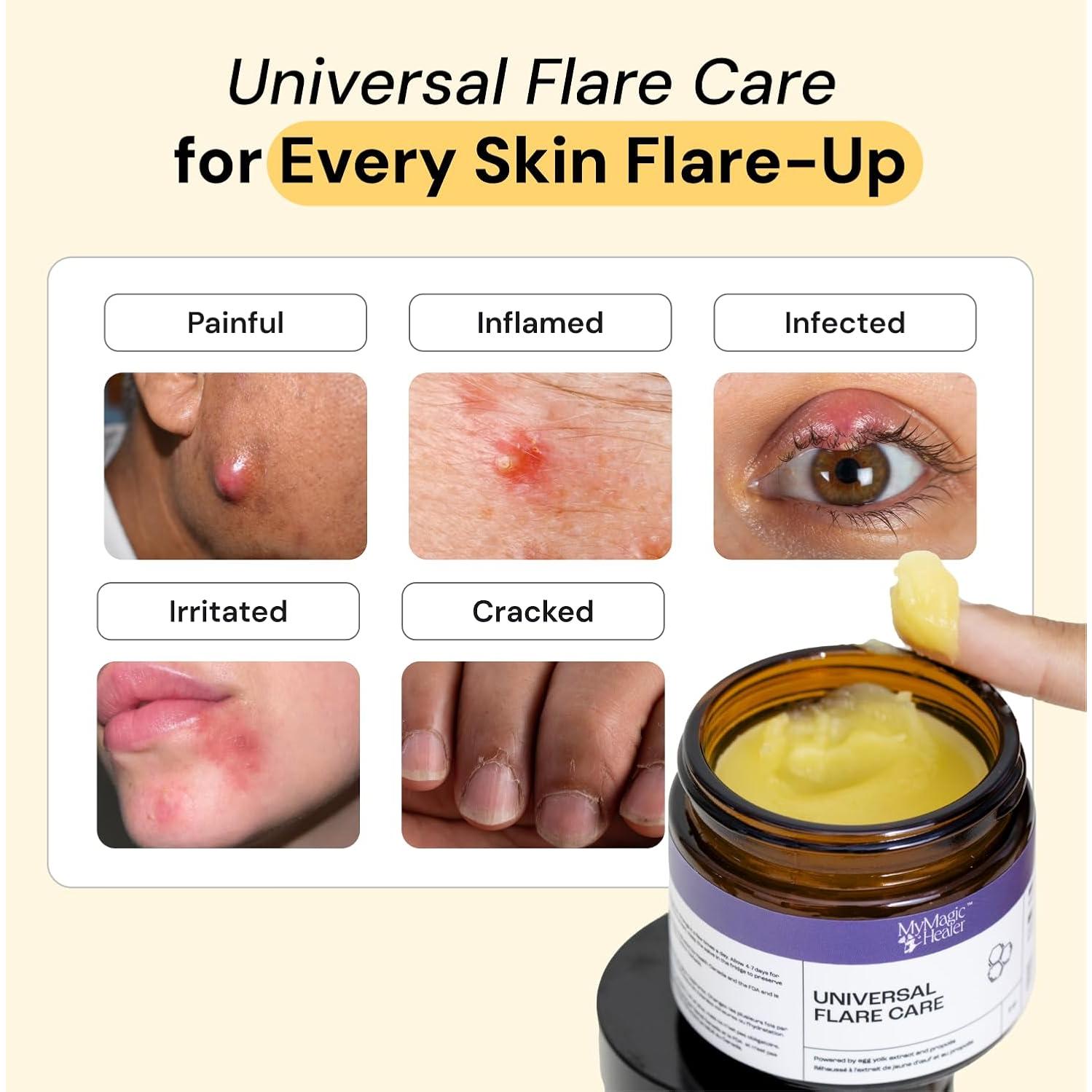 Ungüento Cuidado Flare 2x28.35g - Alivio para Acné y Bultos