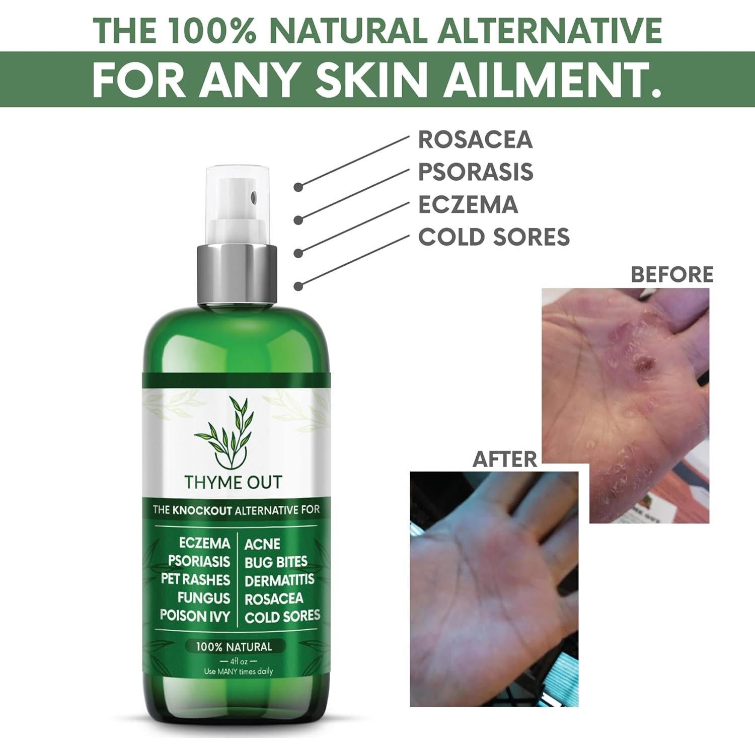 Spray Antipicazón Thyme Out 118ml - Alivio Eczema y Psoriasis