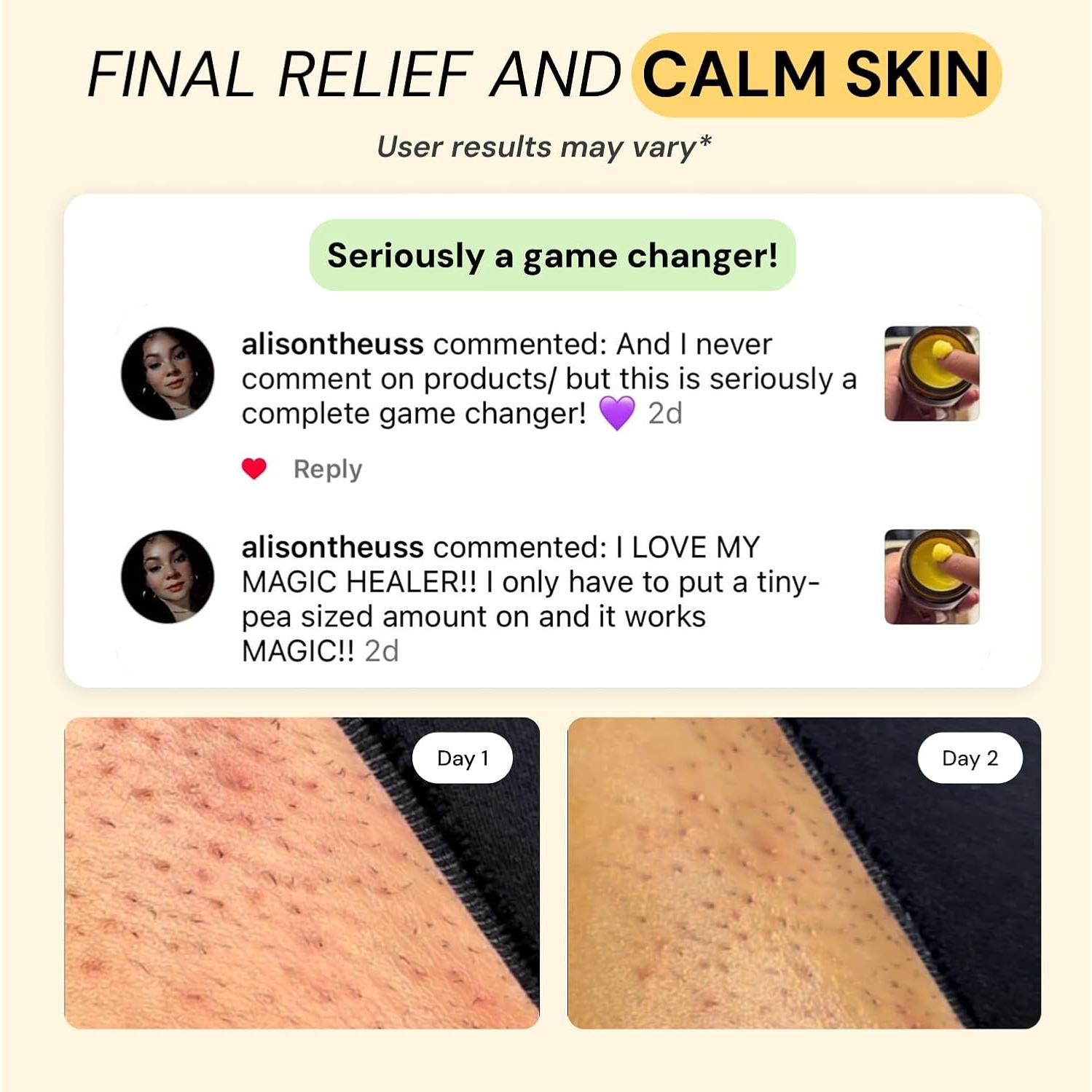 MyMagicHealer Cuidado de Erupciones 113.4 g - Foliculitis, Acné