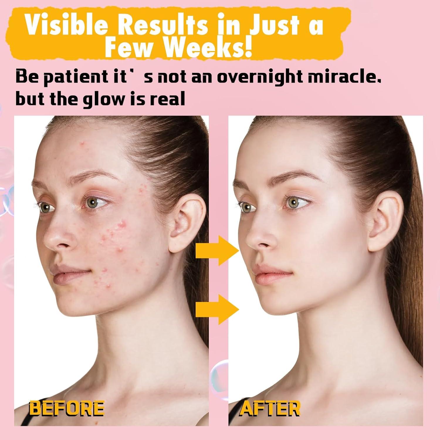 Barra de Jabón de Ácido Kójico Urrznp con Cúrcuma y Limón 2 Unidades