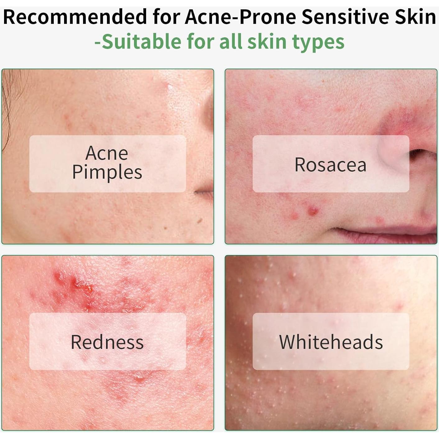 Suero Facial LANBENA 30ml 10% Ácido Salicílico Acné