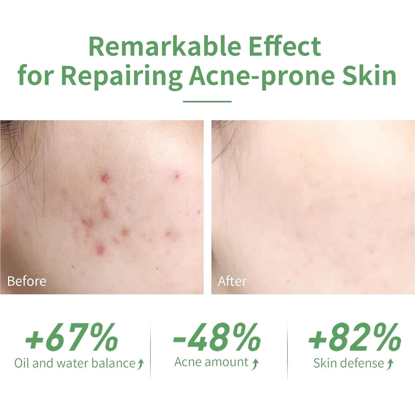 Suero Facial LANBENA 30ml 10% Ácido Salicílico Acné