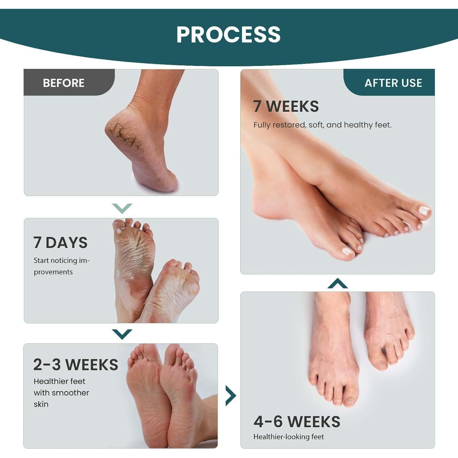 Kit de Cuidado de Pies Aifufand 3 Piezas - Spray Jengibre, Removedor Callos, Crema Hidratante