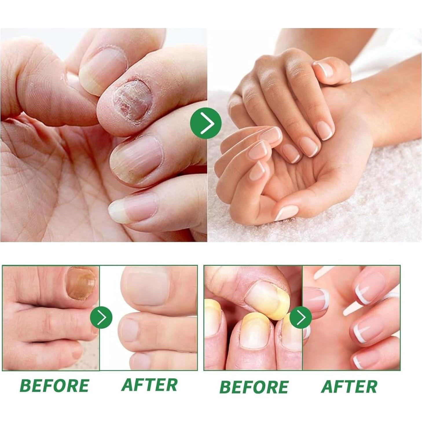 Suero de Uñas de Jengibre Jingchangdian 2 Pcs - Cuidado Cutículas