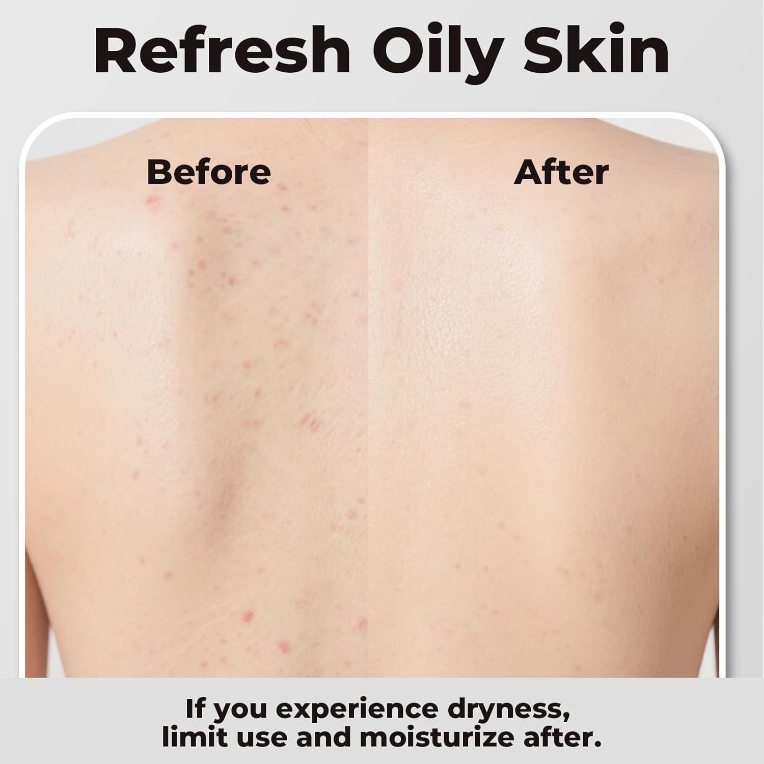 Jabón de Carbón Activado SAISZE 226g para Piel Grasa y Acneica