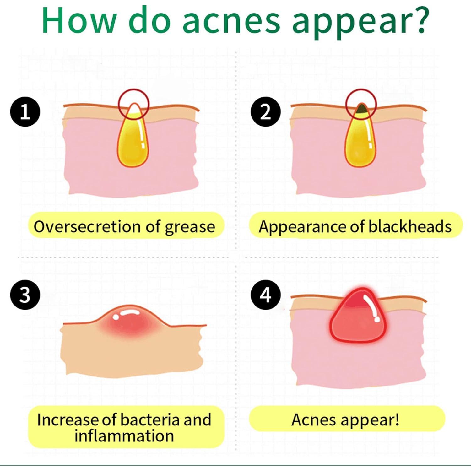 Crema Hidratante Facial Árbol de Té 20.9 ml - Piel Grasa