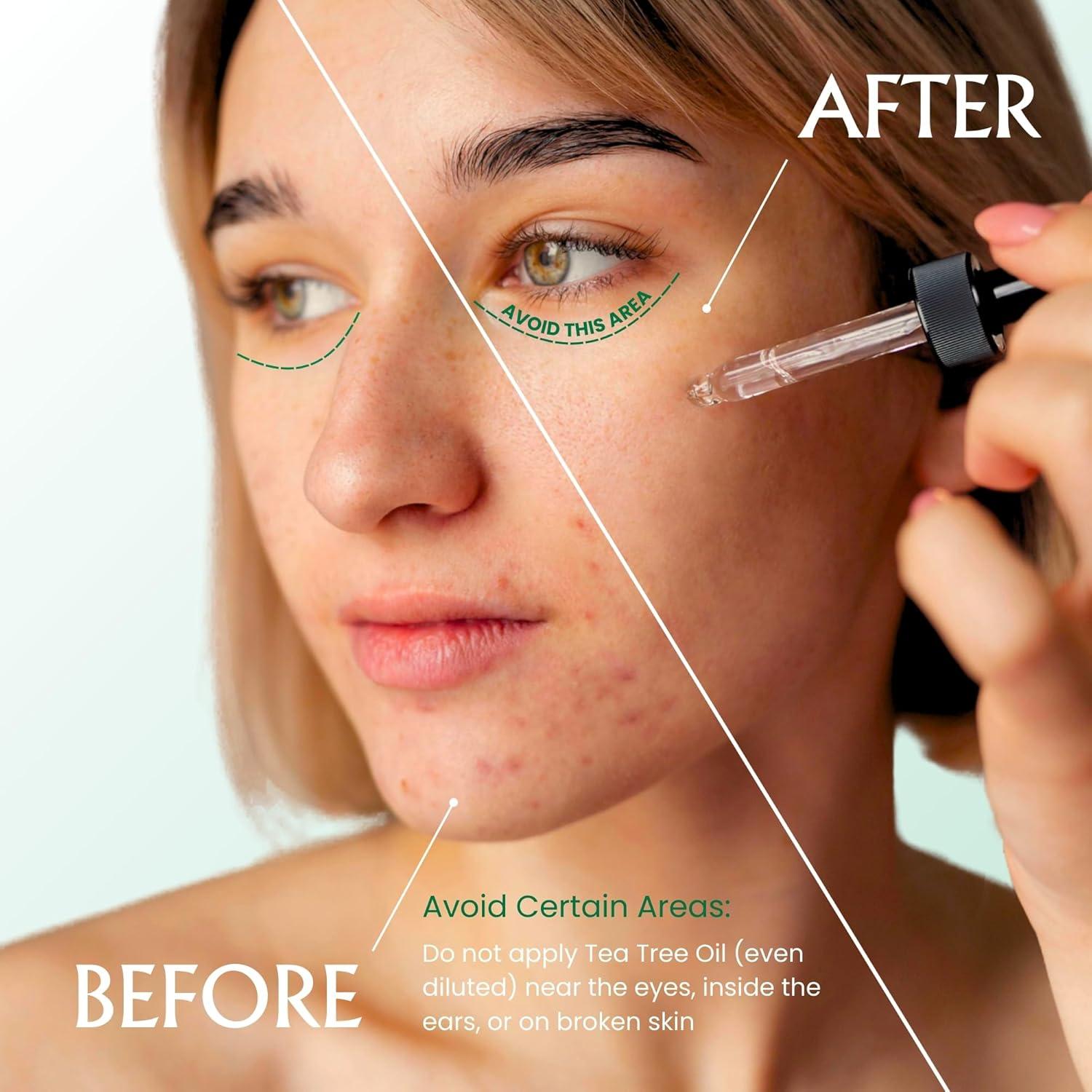 Aceite de Árbol de Té Puro BodyJ4You 30 ml Orgánico