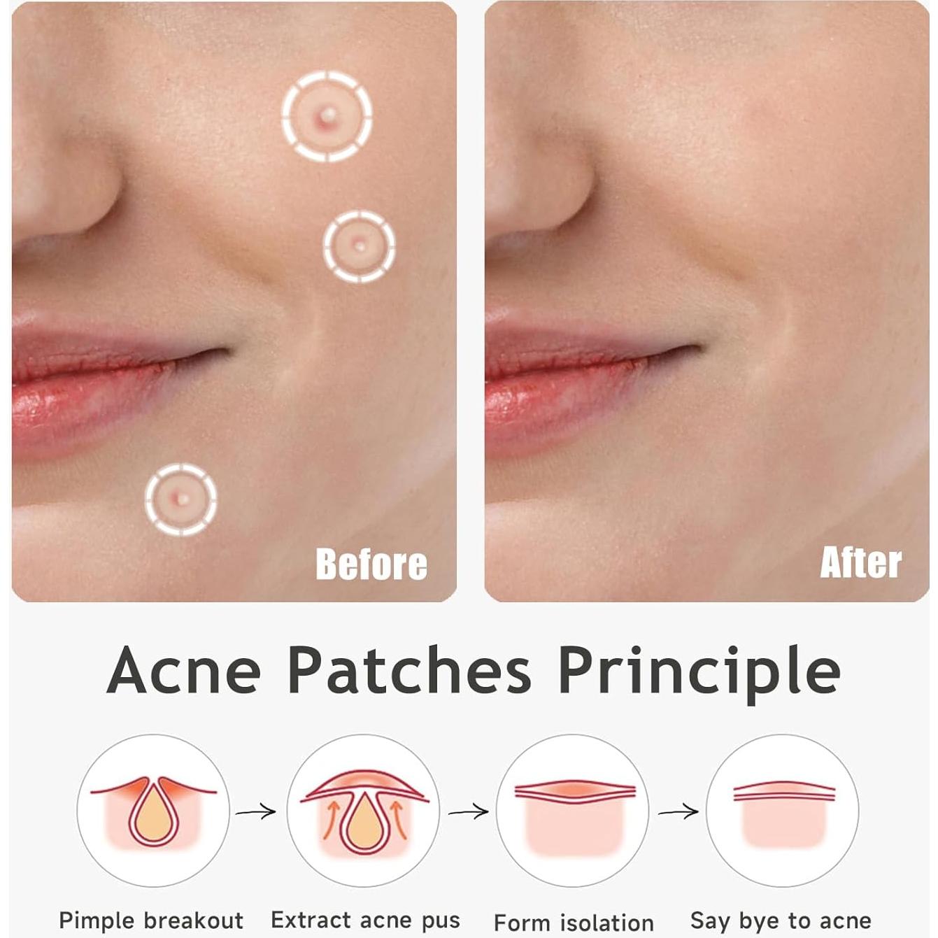 Parche Hidrocoloide Dazzlook 12mm para Granitos - 48 Pcs