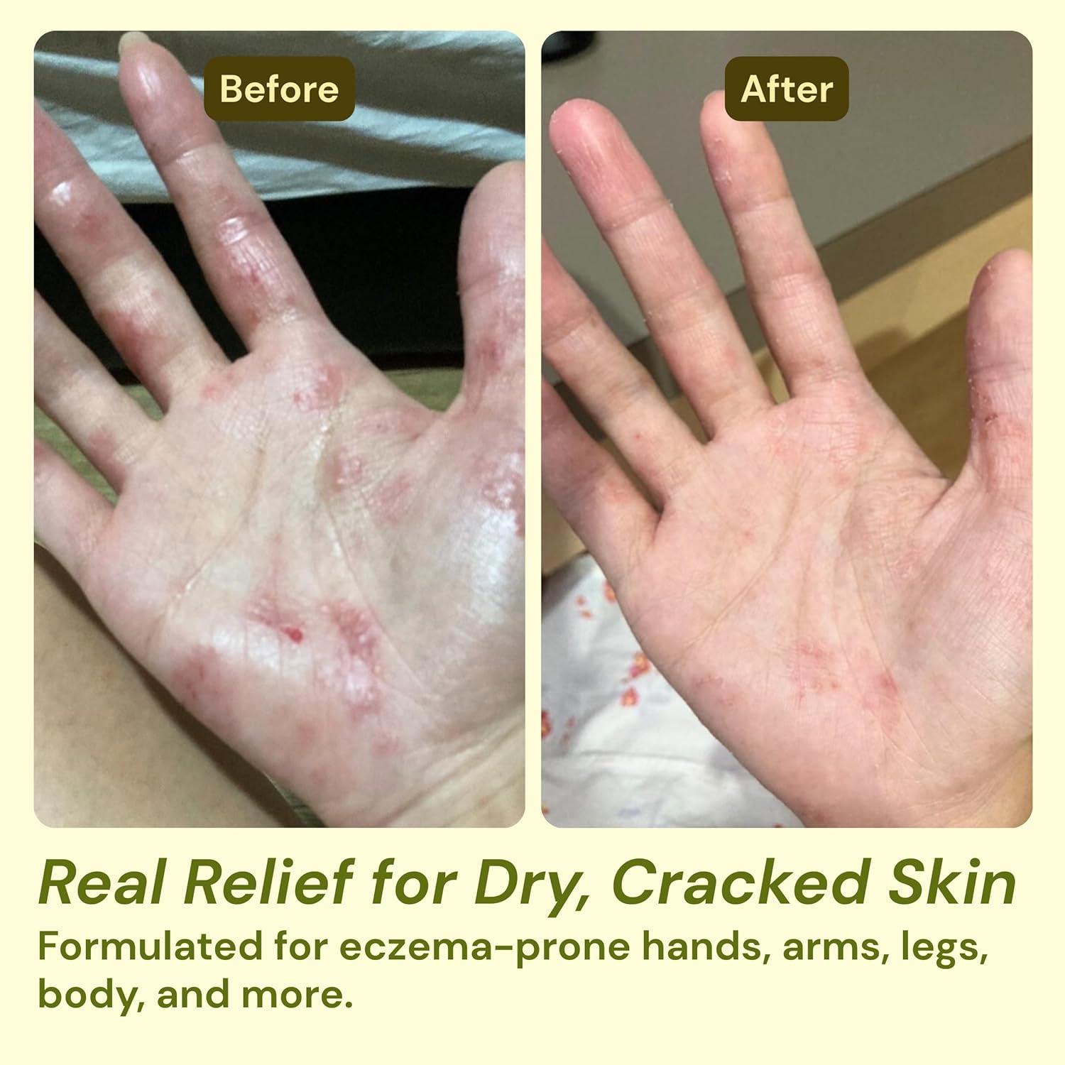 Crema Alivio Eczema Artemisa y Menta 30g Natural Orgánica