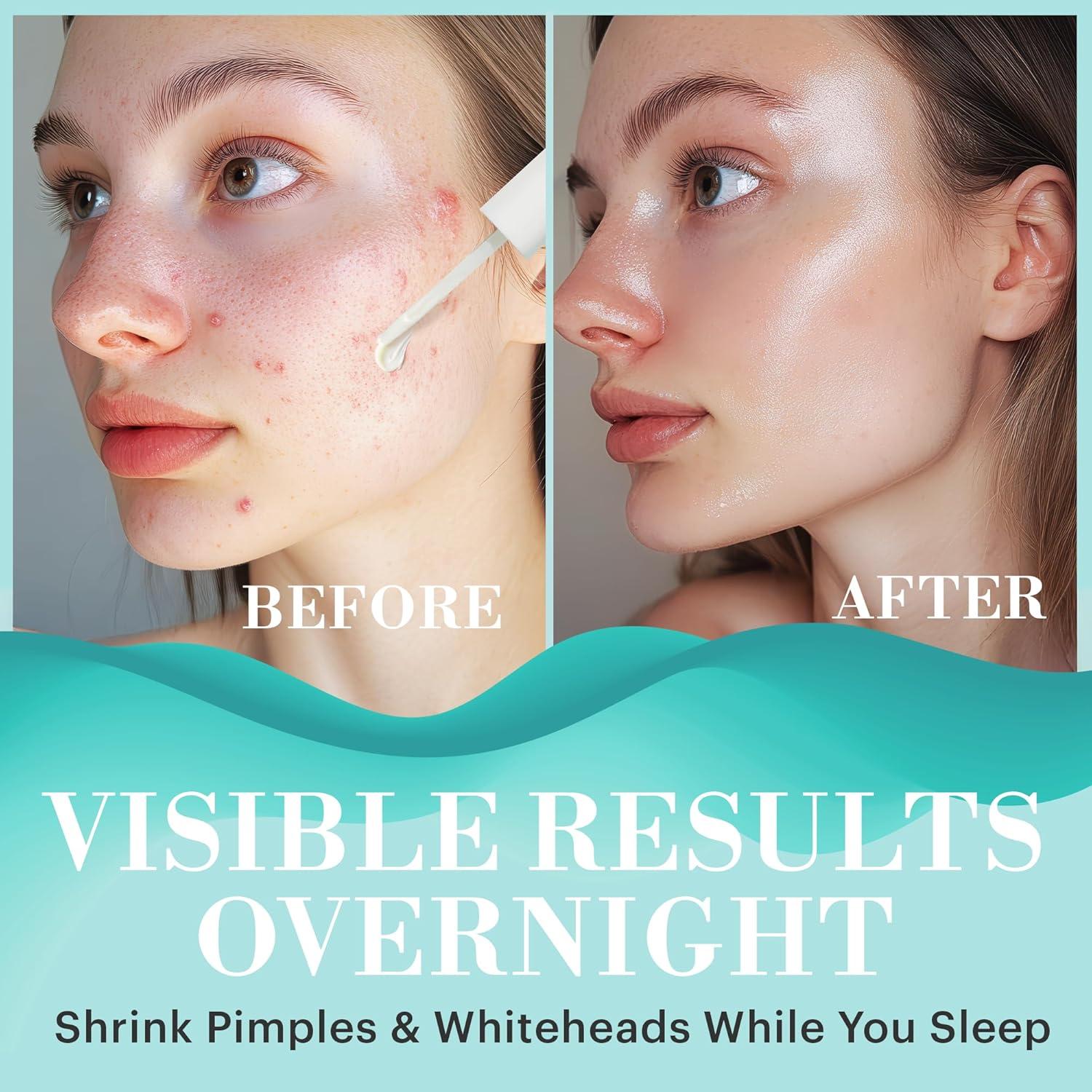 Loción Secante Repechage 0.25 FL - Tratamiento Acné y Manchas