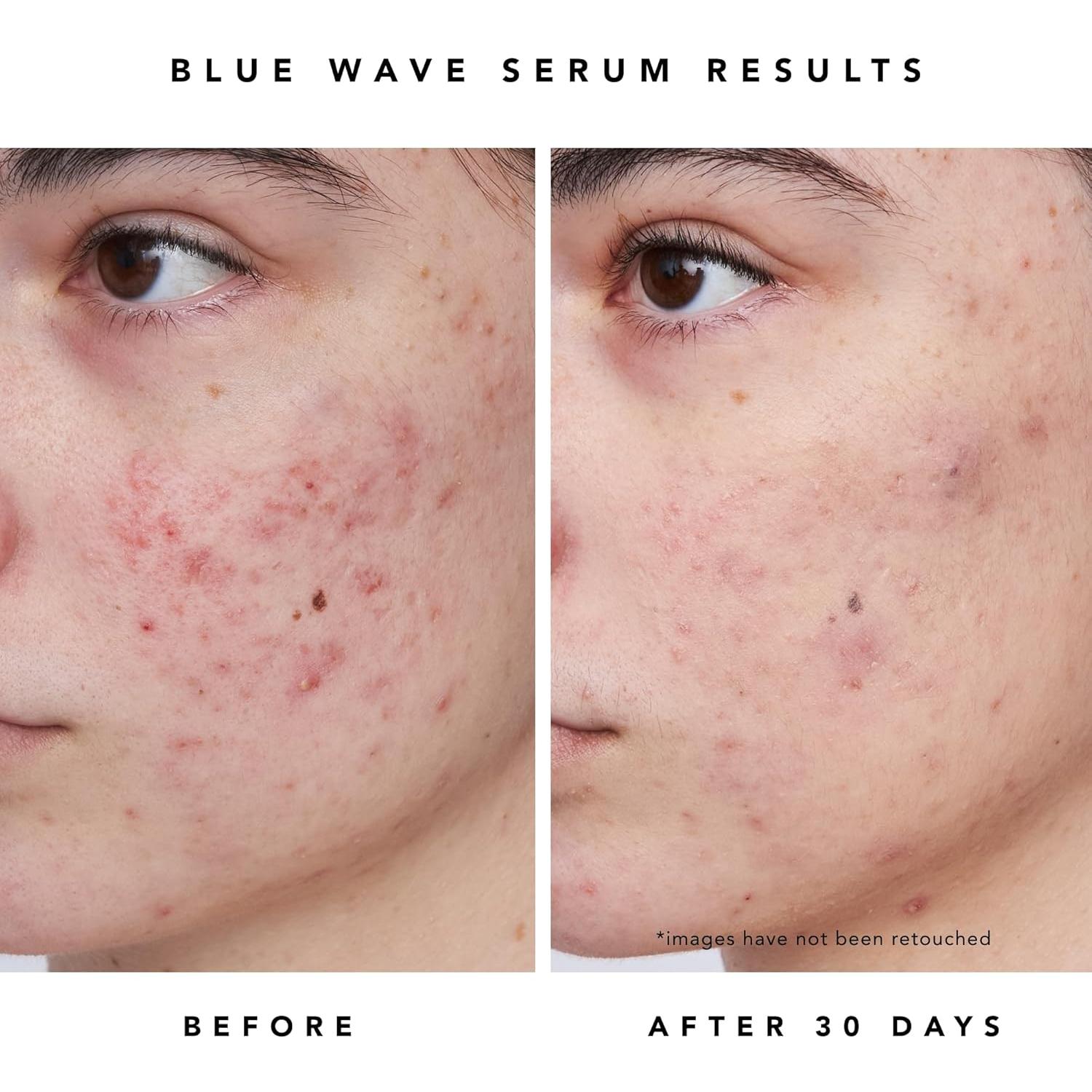 HERBIVORE Blue Besties Duo - Tratamiento 2 pasos para acné