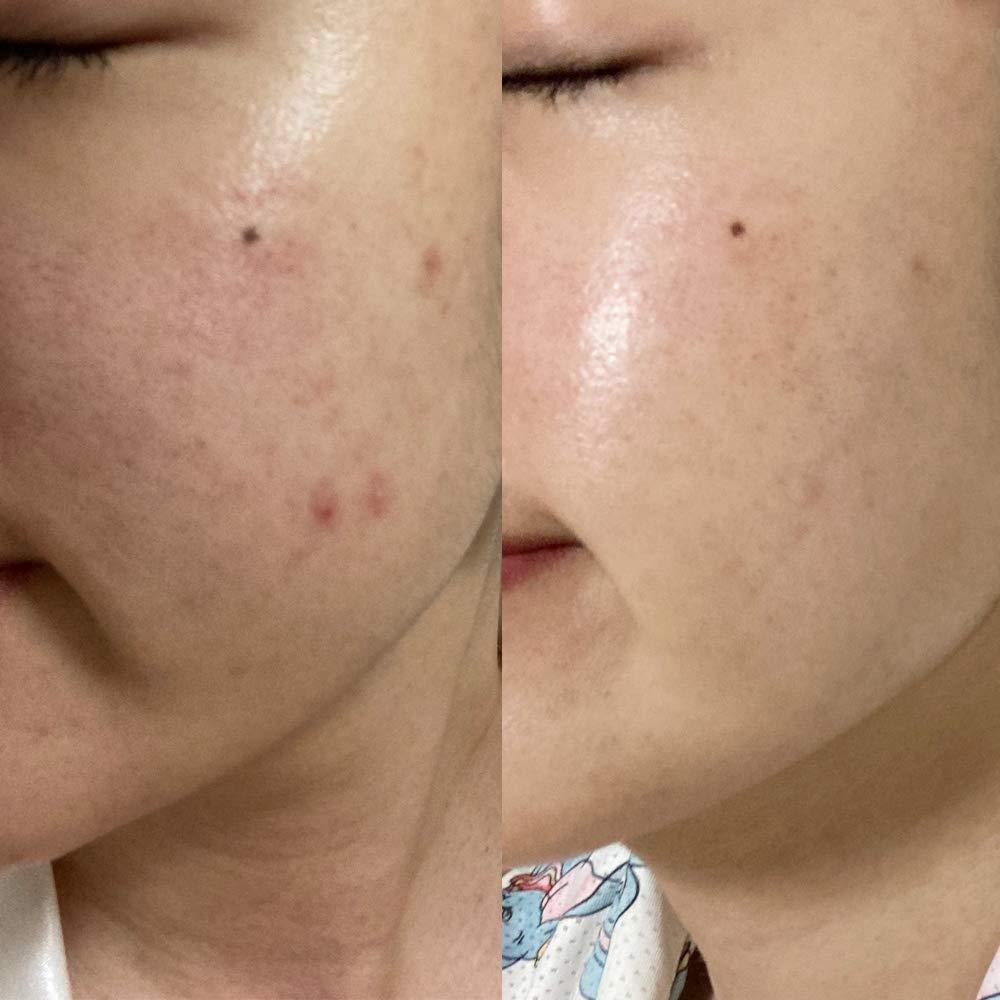 Crema Reparadora Bonajour para Acné 51.24 ml - Cuidado Intensivo