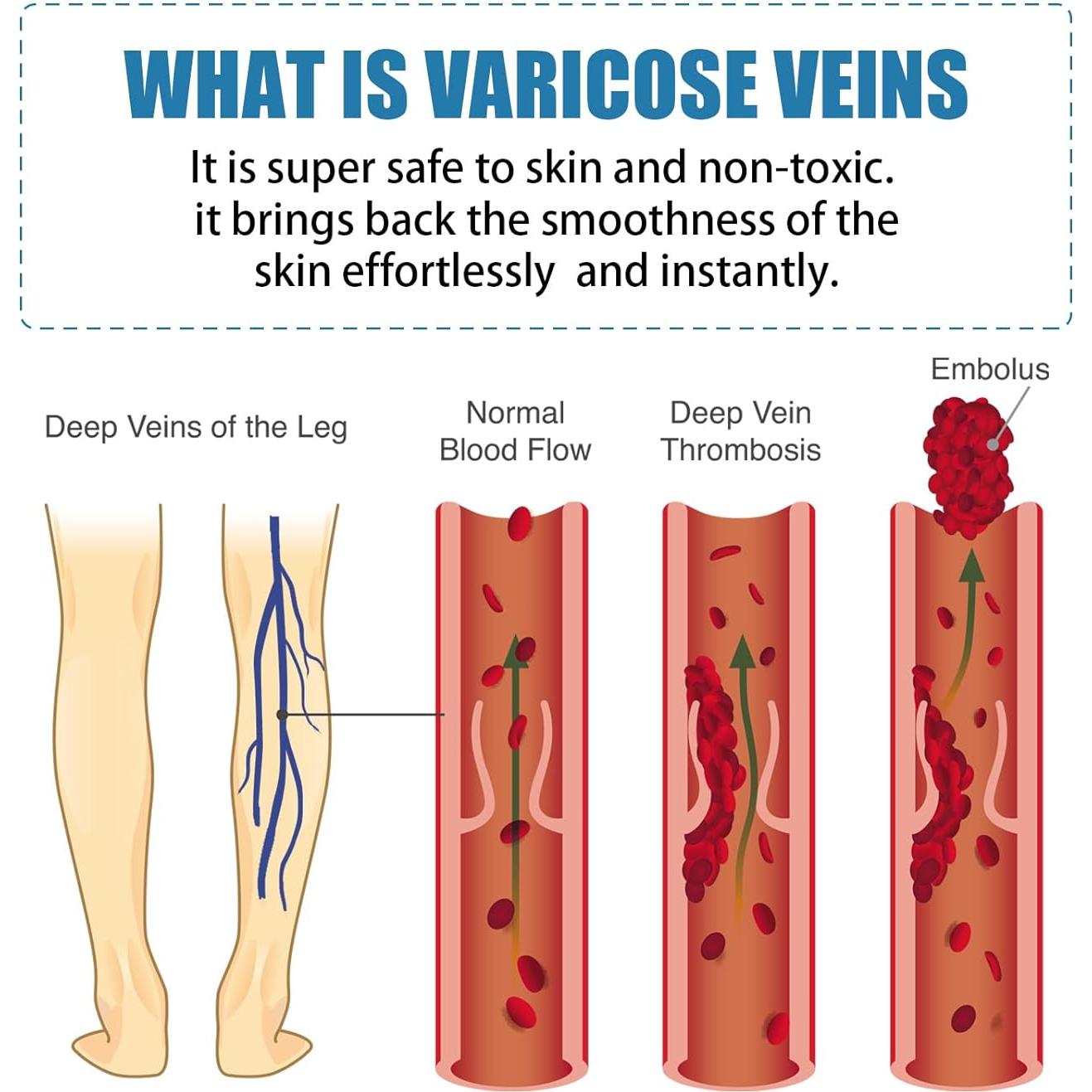 Crema Calmante para Venas Varicosas SUGOYO 39.4 g Alivio Natural