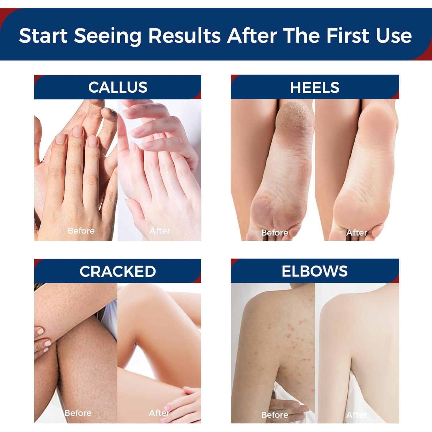 Crema de Urea OUKEYA 42% con 2% Ácido Salicílico - 3 Tubos 85g