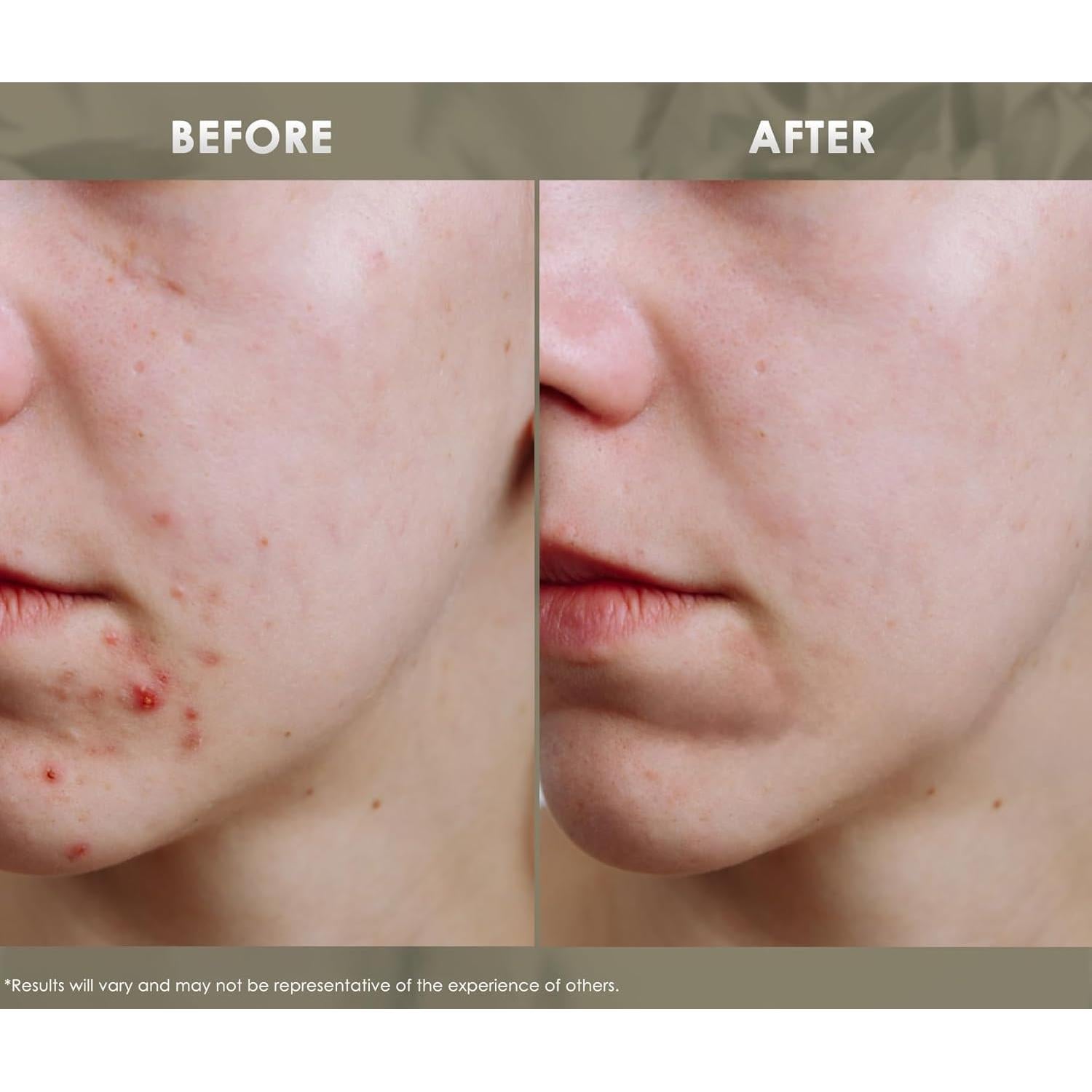 Aceite Esencial Facial Clear Acne Redmint 20ml - Natural y Orgánico