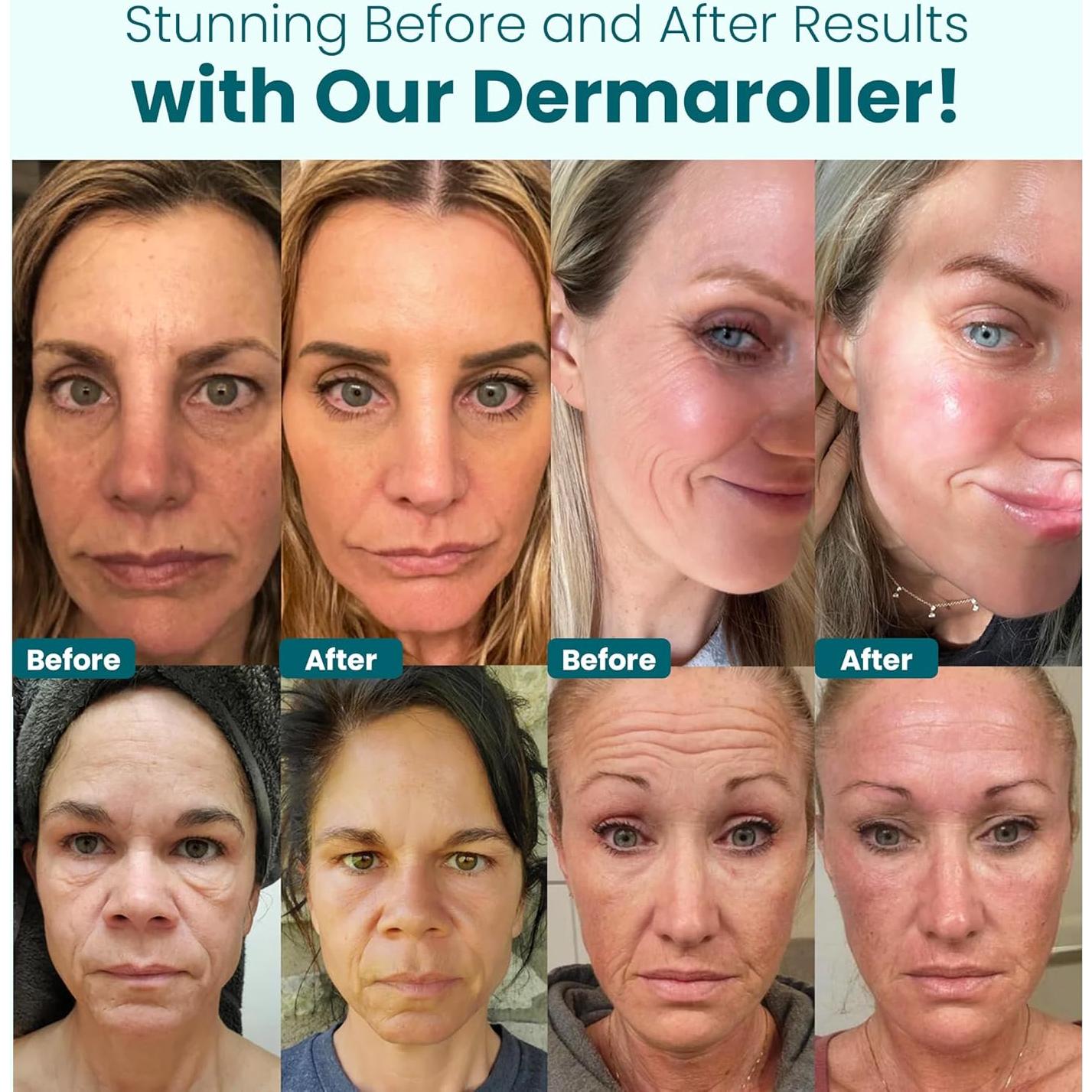 Rodillo Derma Gin Amber Beauty 192 Agujas 0.25mm Reemplazable