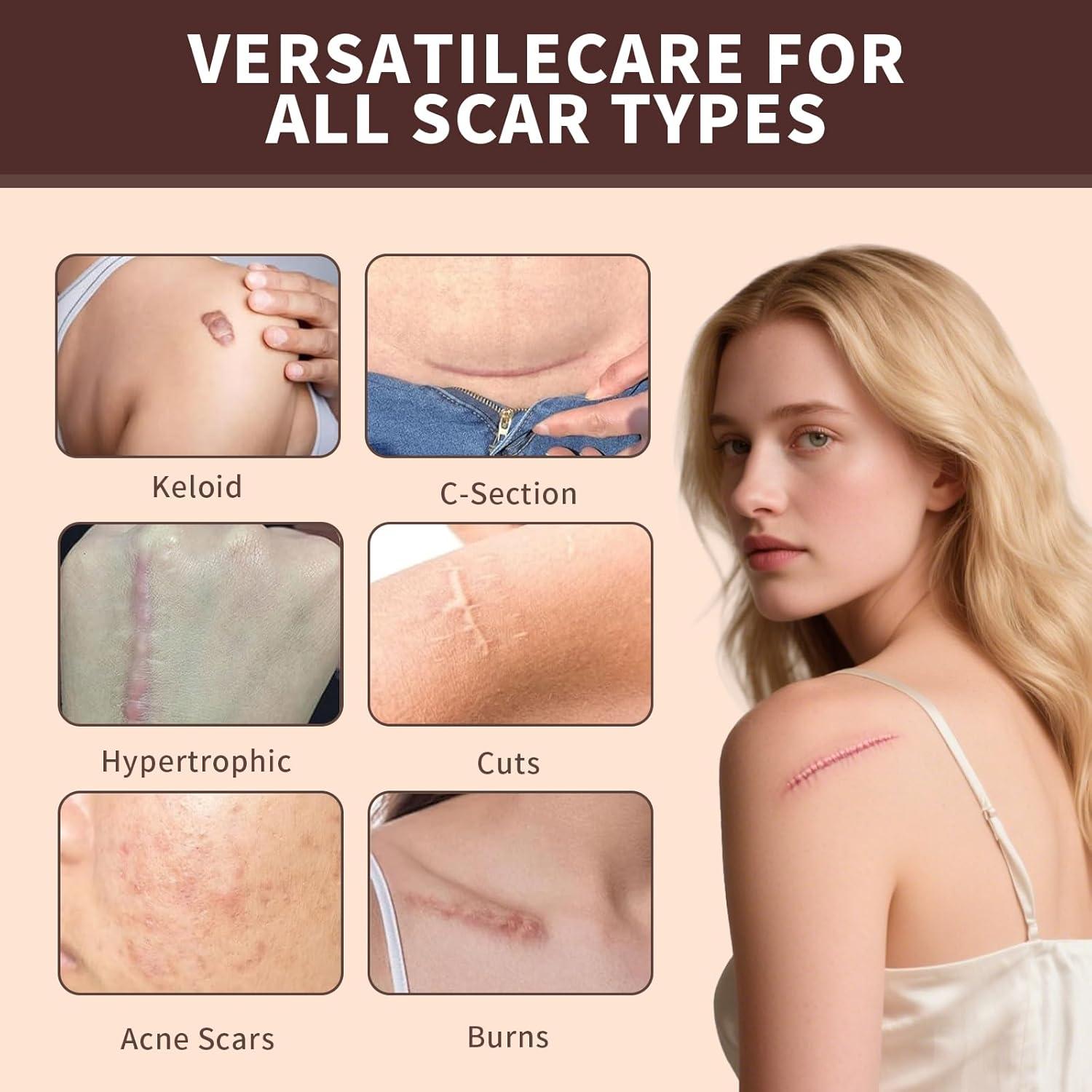 Barra de Silicona para Cicatrices Prequel Skin 60% 140g