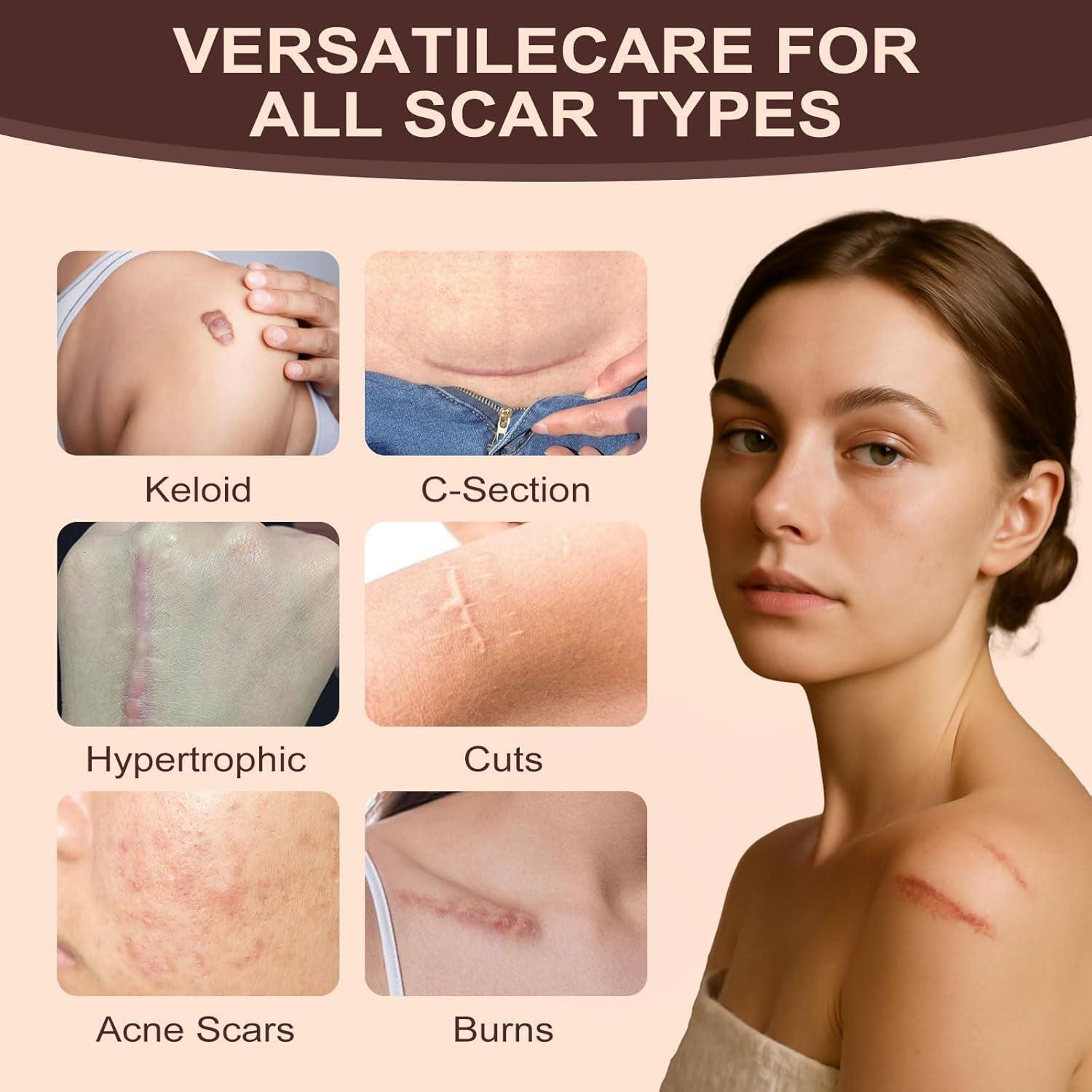 Stick de Silicona para Cicatrices RIWYDMA 60% 20g