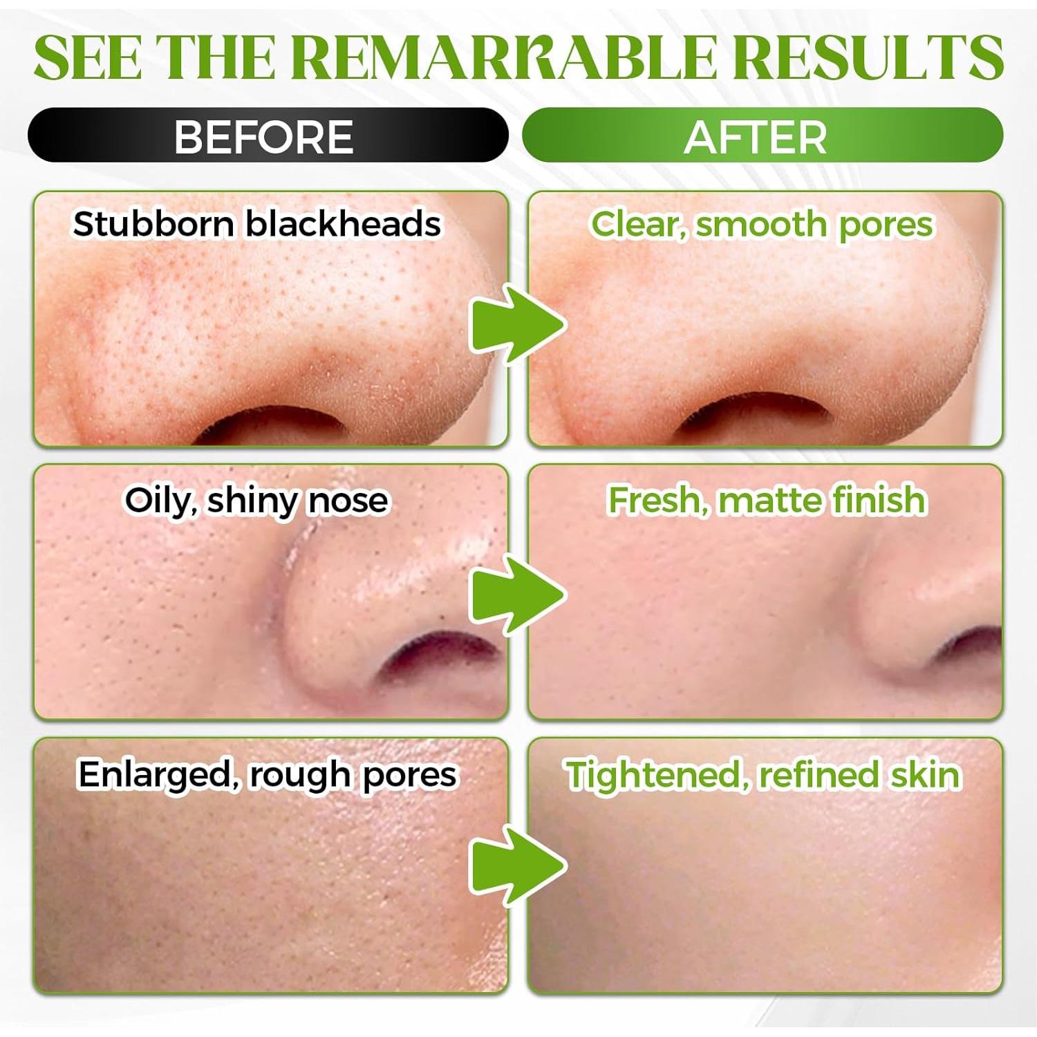 Tiras Removedoras de Puntos Negros Tiepetly - Limpieza Profunda