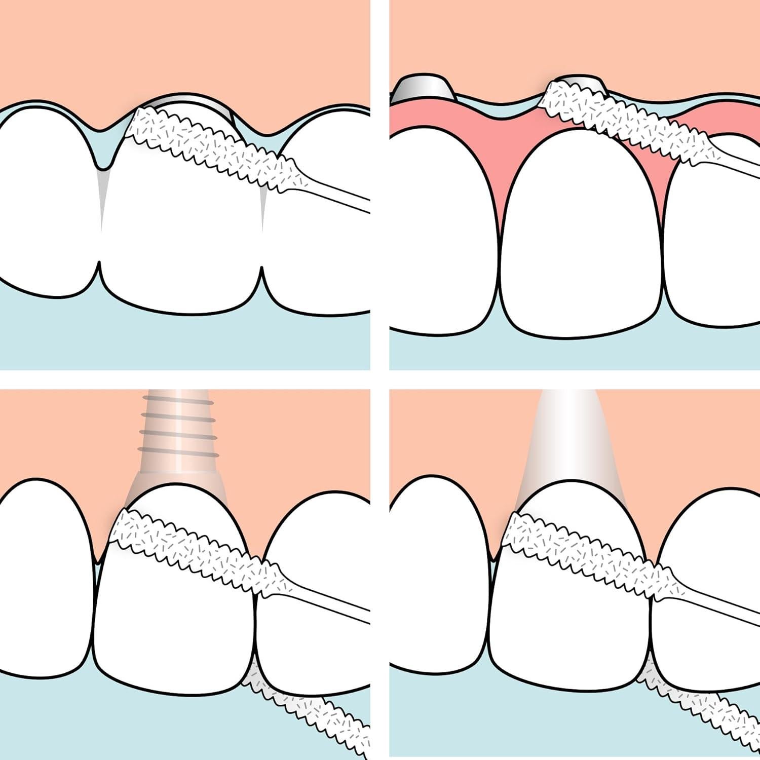 Hilo Dental TePe para Puentes e Implantes - 30 Piezas