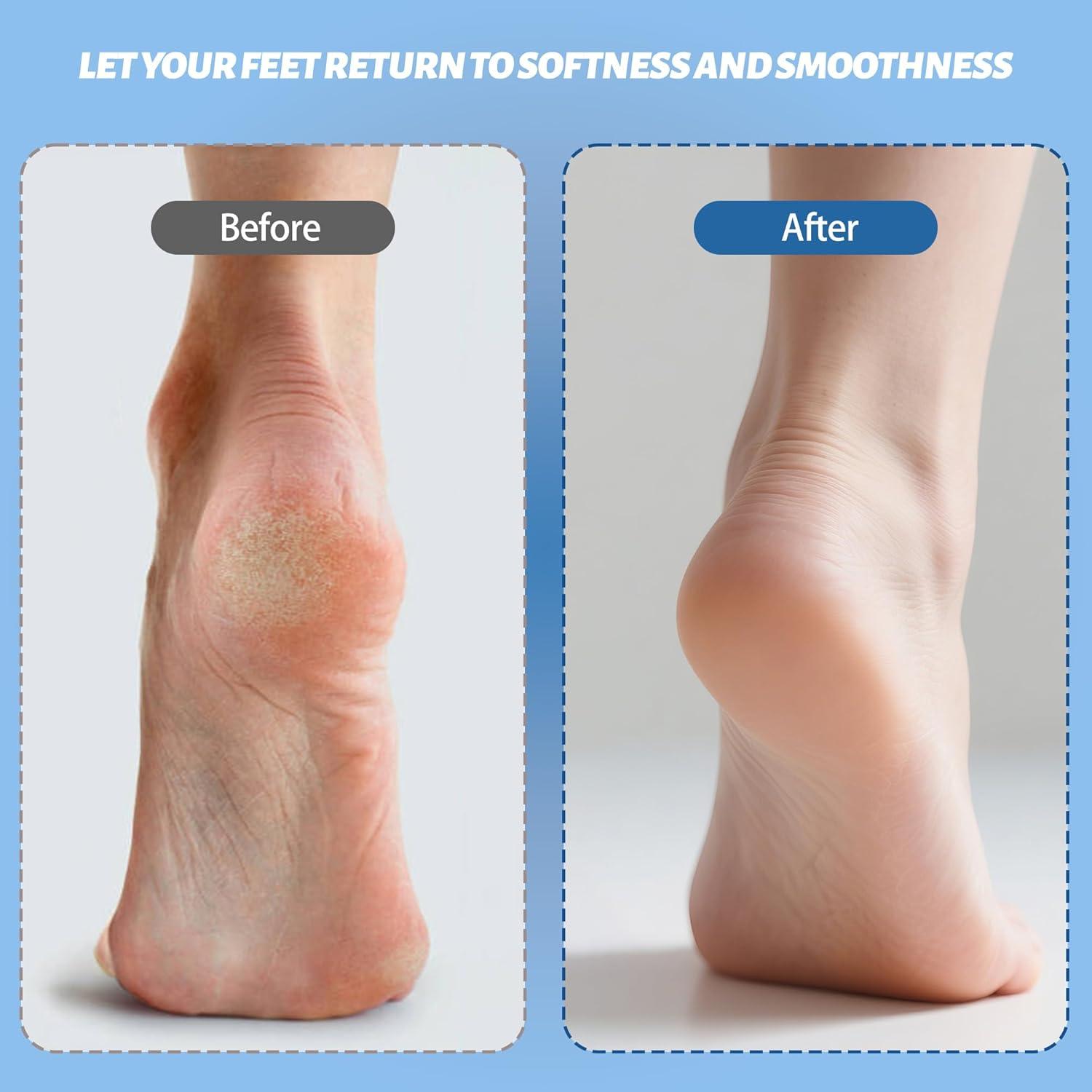 Removedor de Callos Eléctrico Doeean 17 en 1 con Vacío IPX6