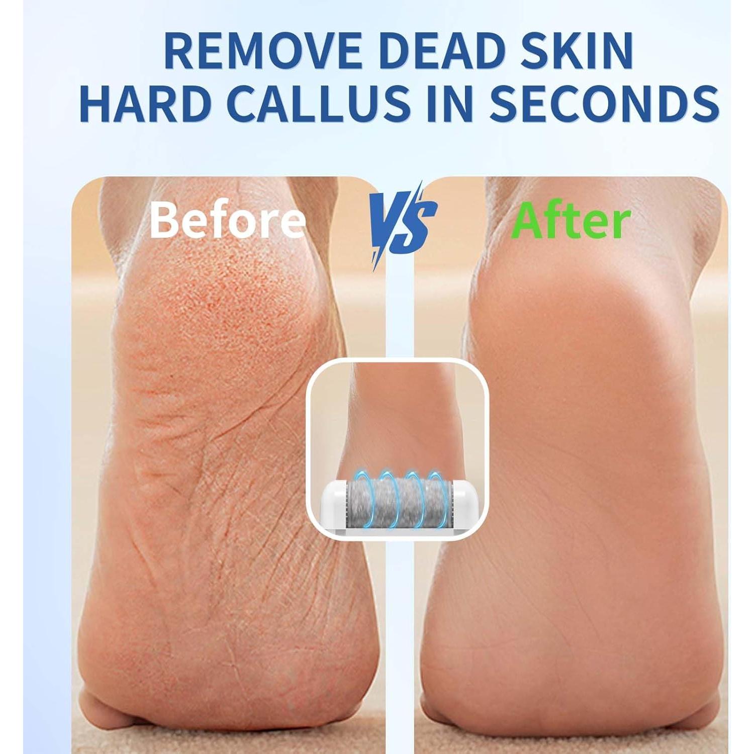 Removedor de Callos Eléctrico Recargable FERRY MJQ01 - Lima Inalámbrica para Pies Suaves