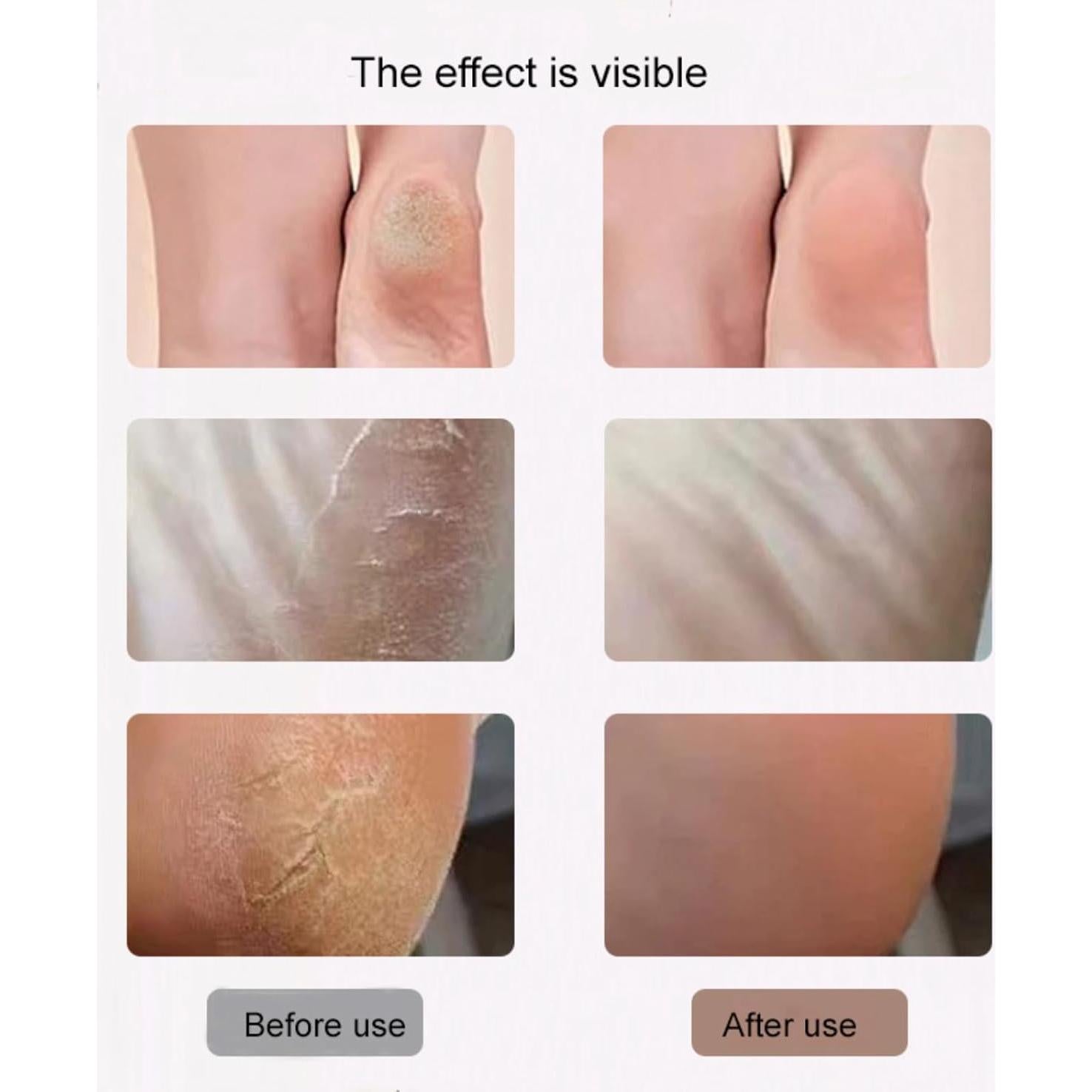 Removedor de Callos Eléctrico Genérico Efcr-001 Portátil